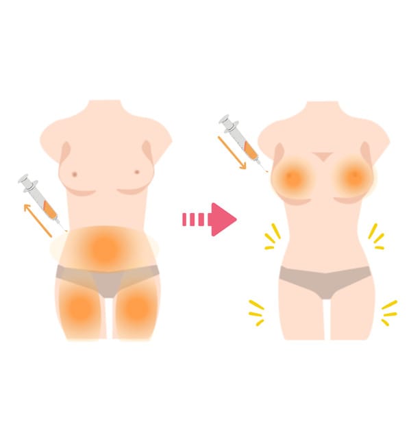Diagram showing fat harvested from the abdomen and thighs injected into the breast for augmentation
