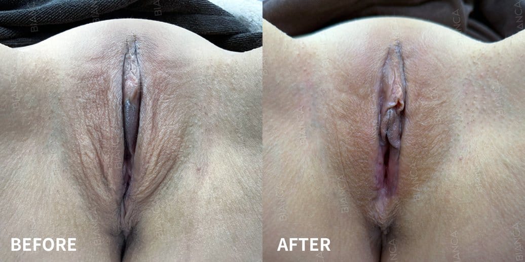 Labia majora reduction case photo