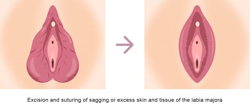 Labia majora reduction procedure diagram