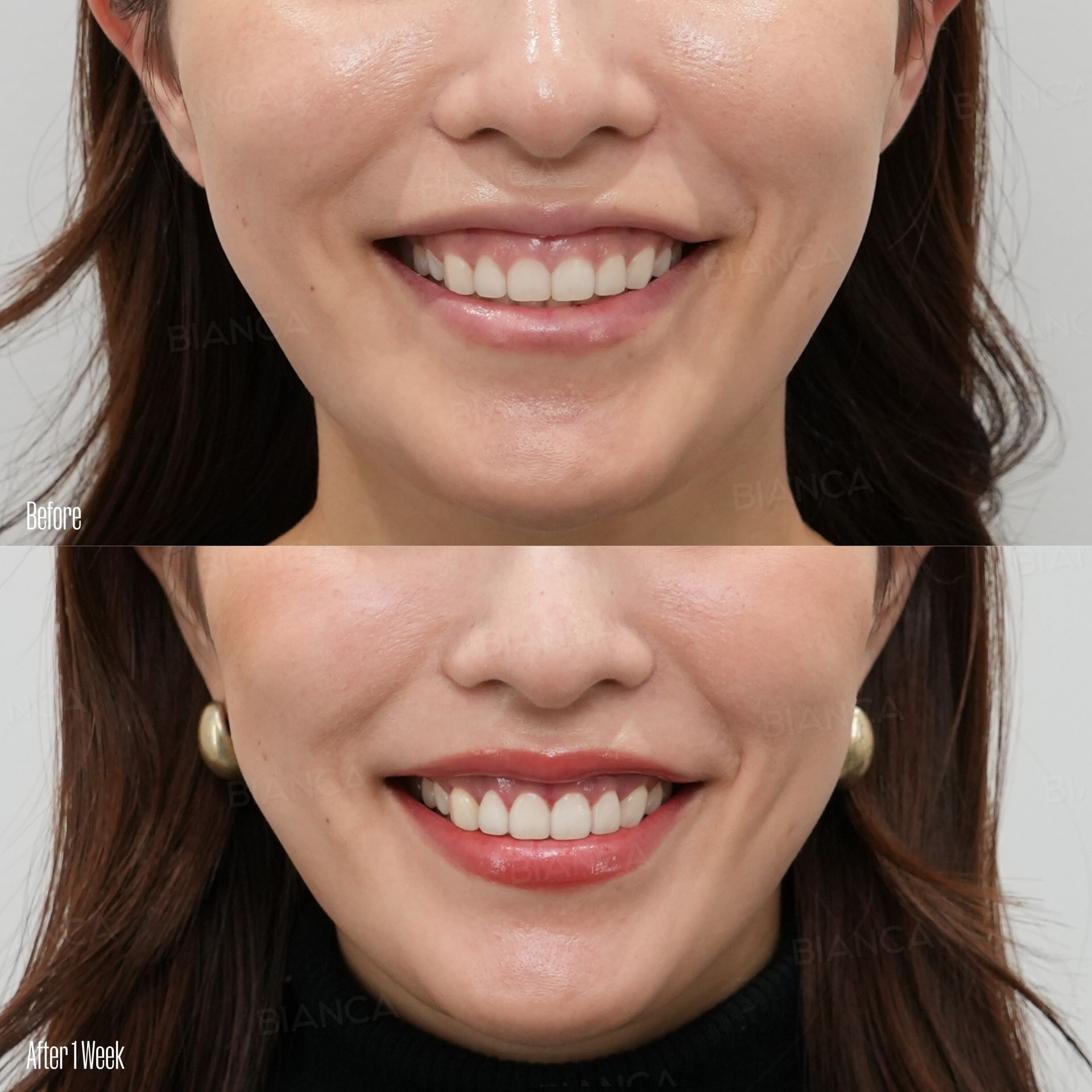 Gummy smile correction before and after treatment limiting how far the upper lip rises, front view of the mouth compared while smiling