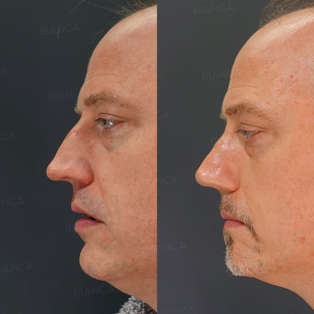 Hump Excision, Nasal Bone Osteotomy with Narrowing