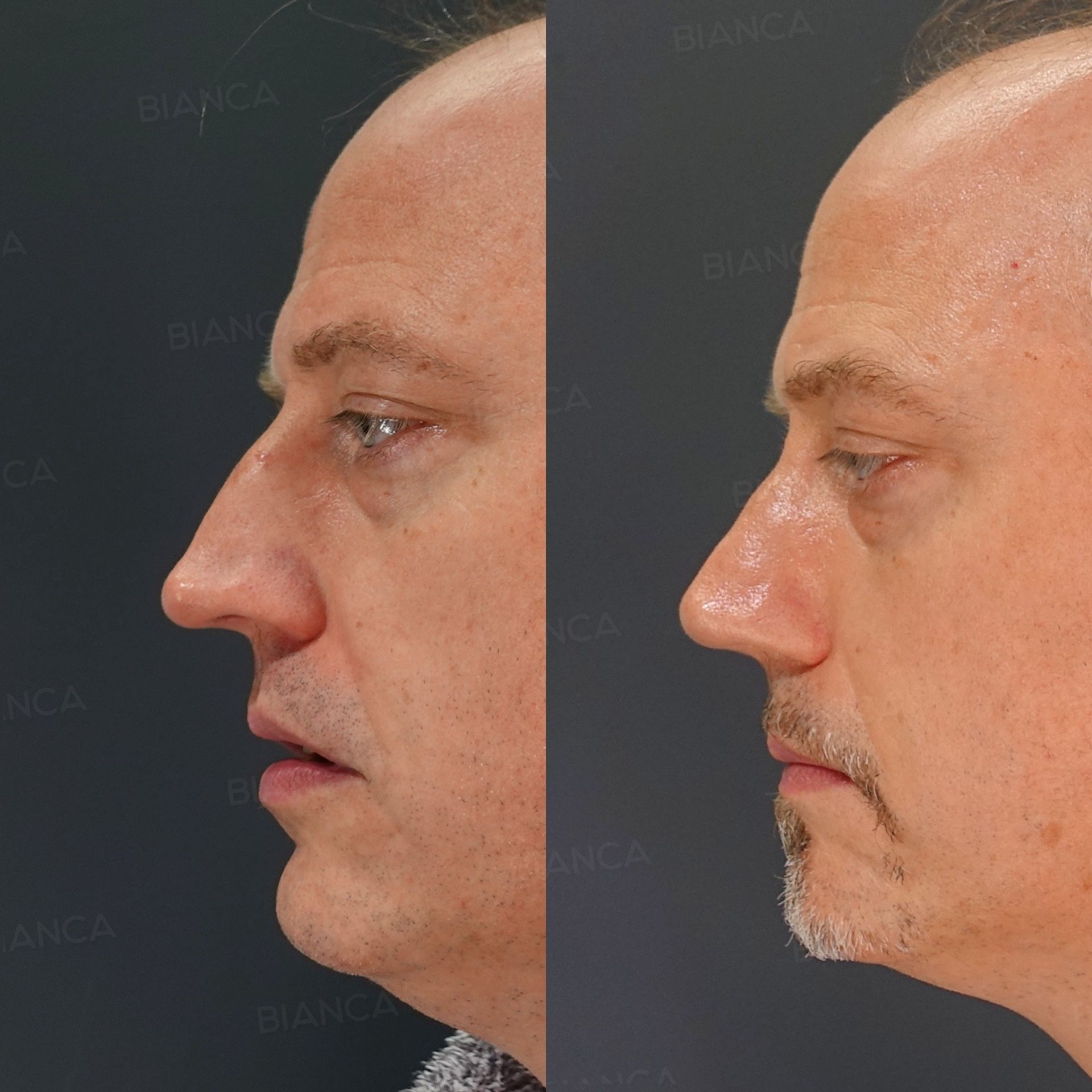 Hump Excision, Nasal Bone Osteotomy with Narrowing