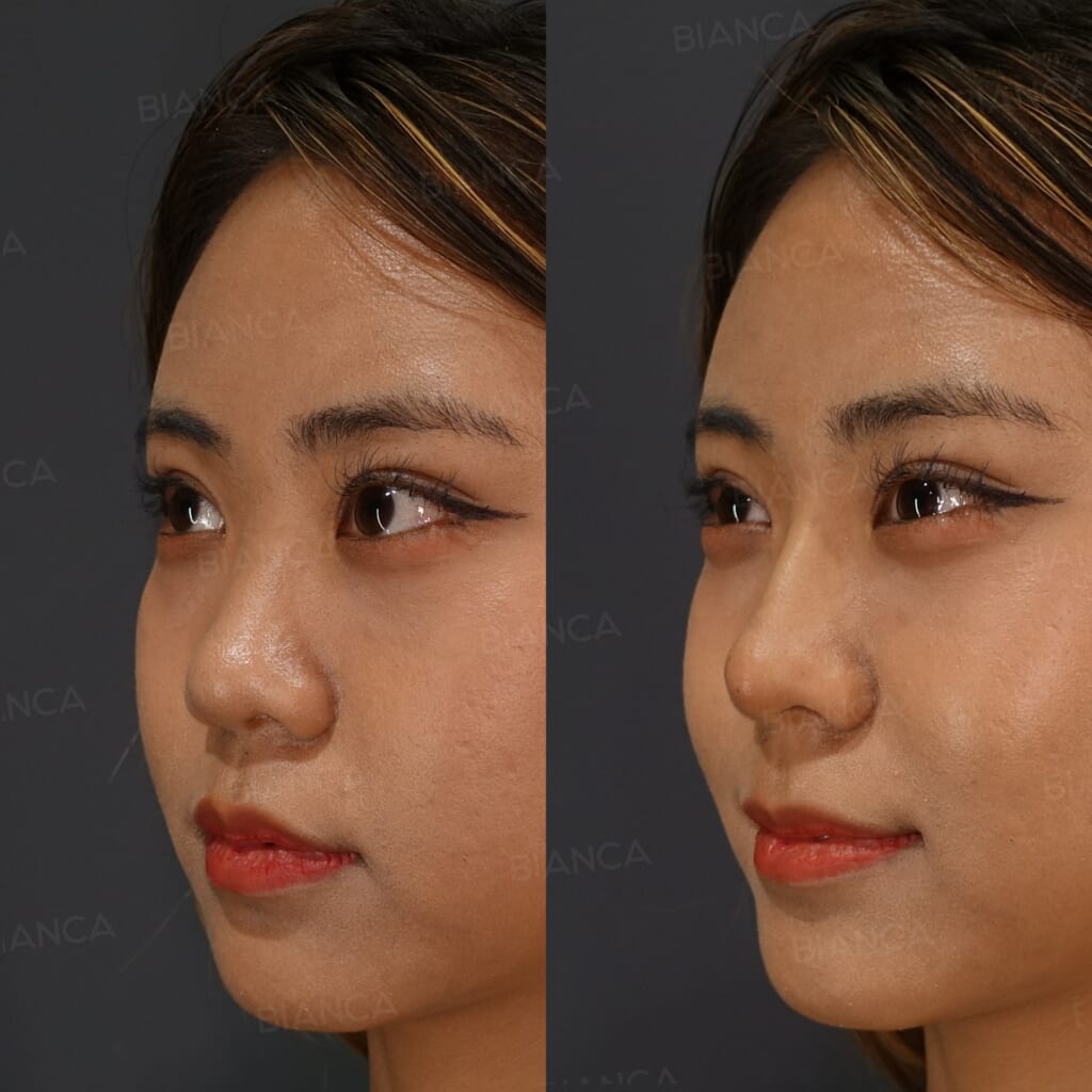 Hyaluronic Acid Filler (Nasal Tip) before and after, immediately after treatment, BIANCA CLINIC Tokyo