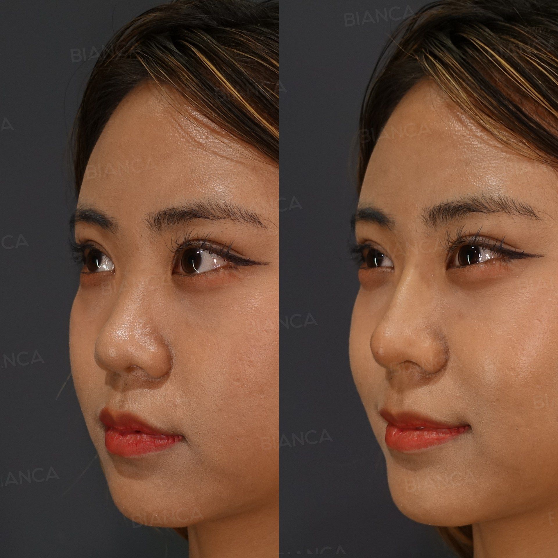 Hyaluronic Acid Filler (Nasal Tip) before and after, immediately after treatment, BIANCA CLINIC Tokyo
