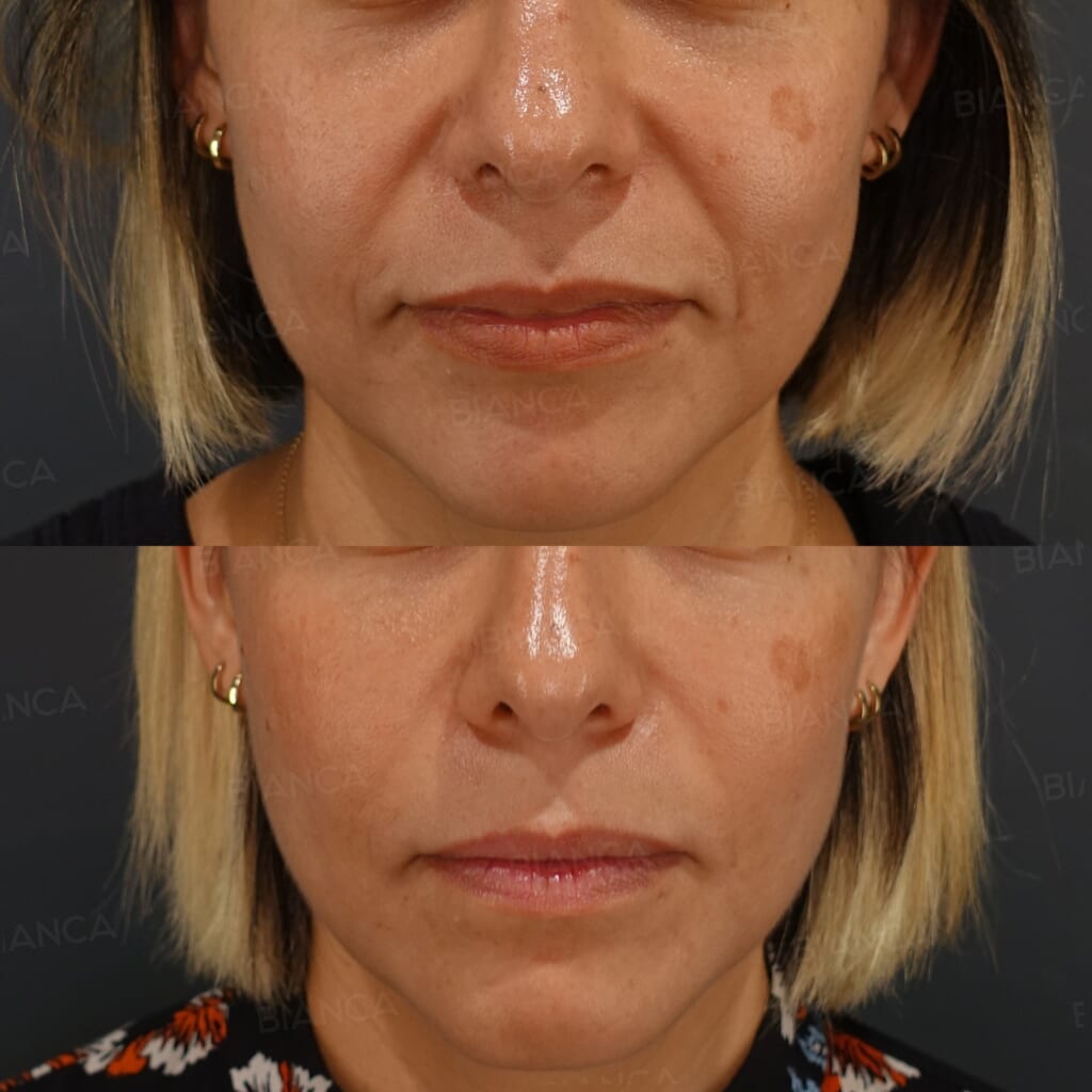 Hyaluronic Acid Filler (Cheeks and Nasolabial Folds) before and after, 1 week, BIANCA CLINIC Tokyo