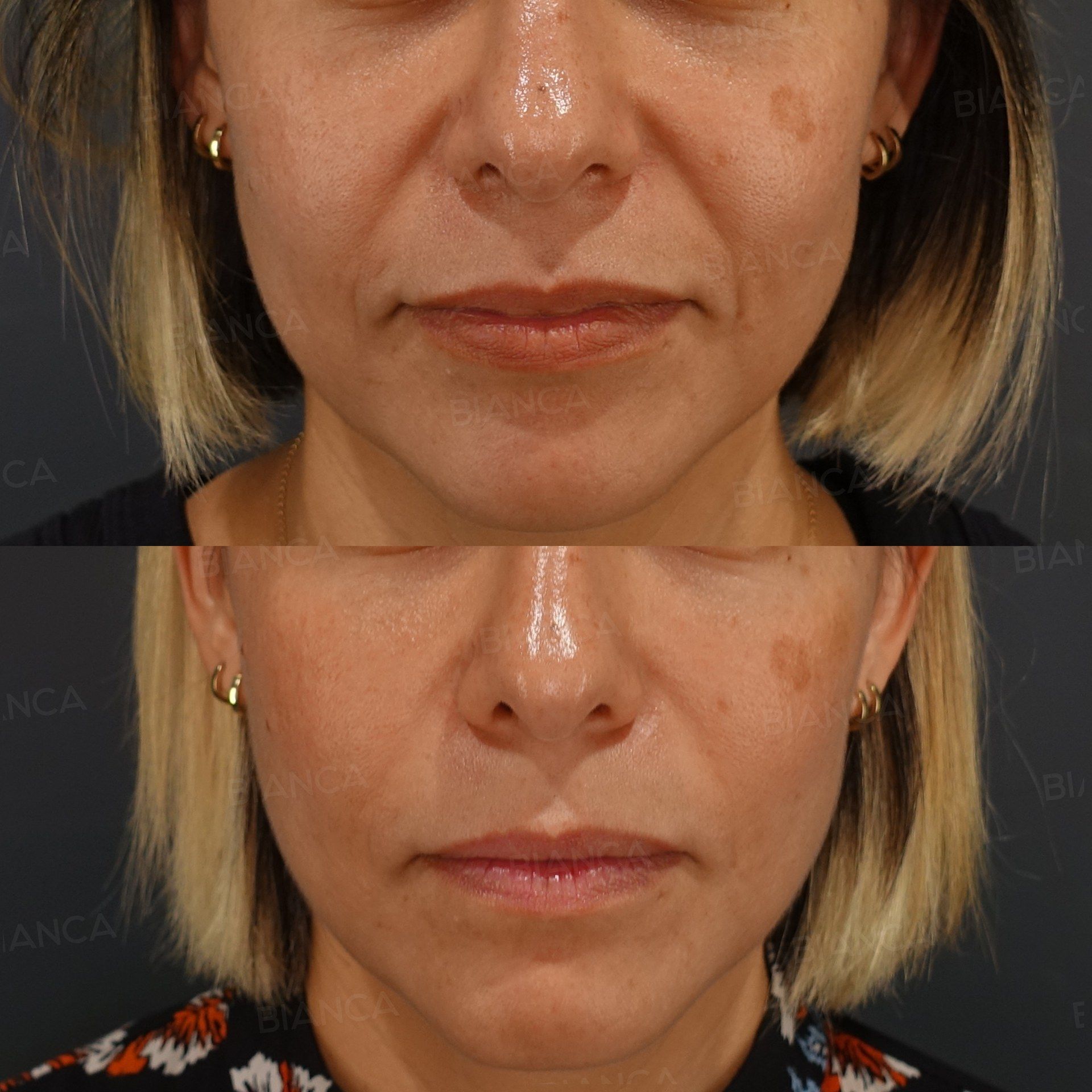 Hyaluronic Acid Filler (Cheeks and Nasolabial Folds) before and after, 1 week, BIANCA CLINIC Tokyo