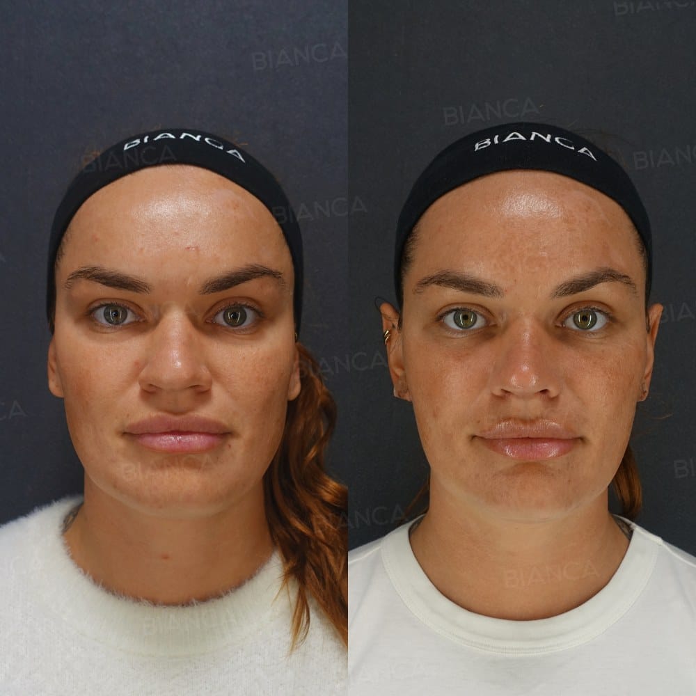 Hyaluronic Acid Filler (Under Eyes and Lips) + BIANCA LIFT (7 Threads) before and after, 3 weeks, BIANCA CLINIC Tokyo