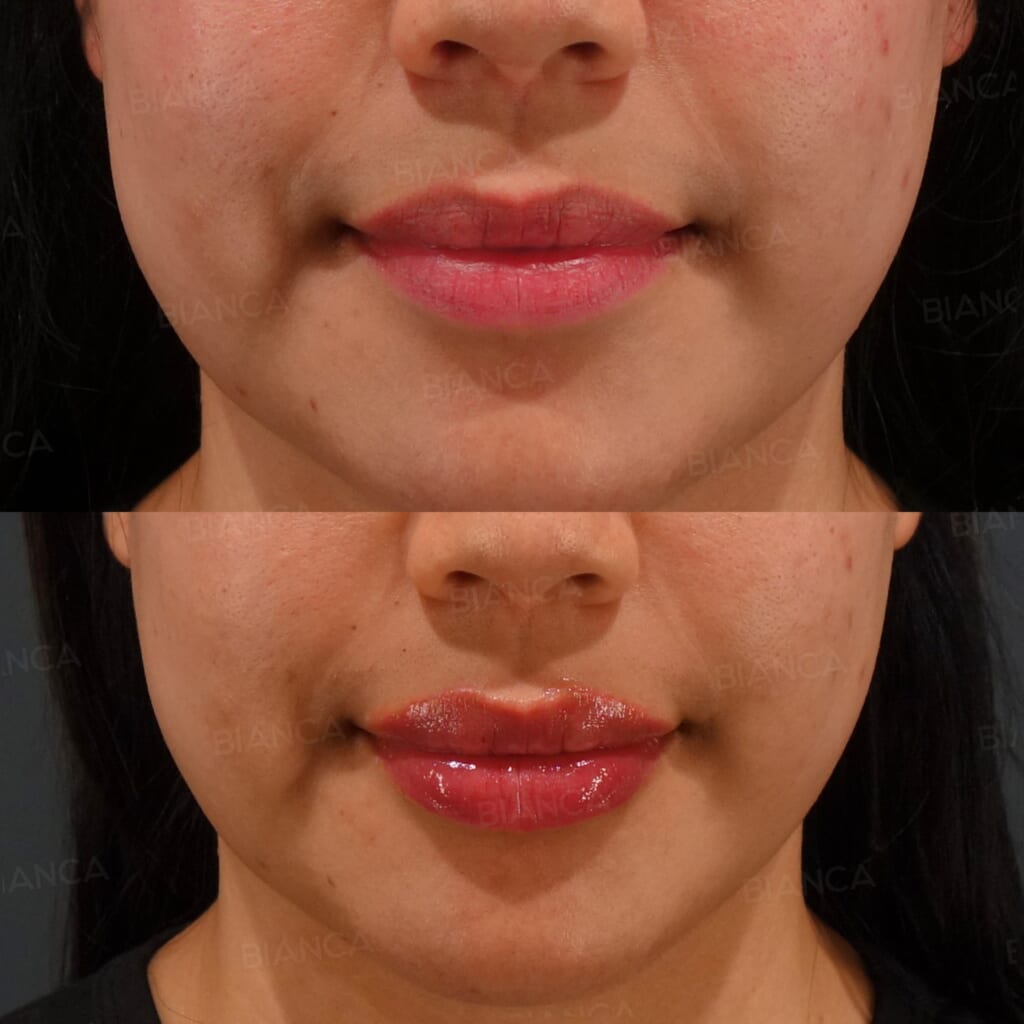 Hyaluronic Acid Filler (Lips) before and after, 1 month, BIANCA CLINIC Tokyo