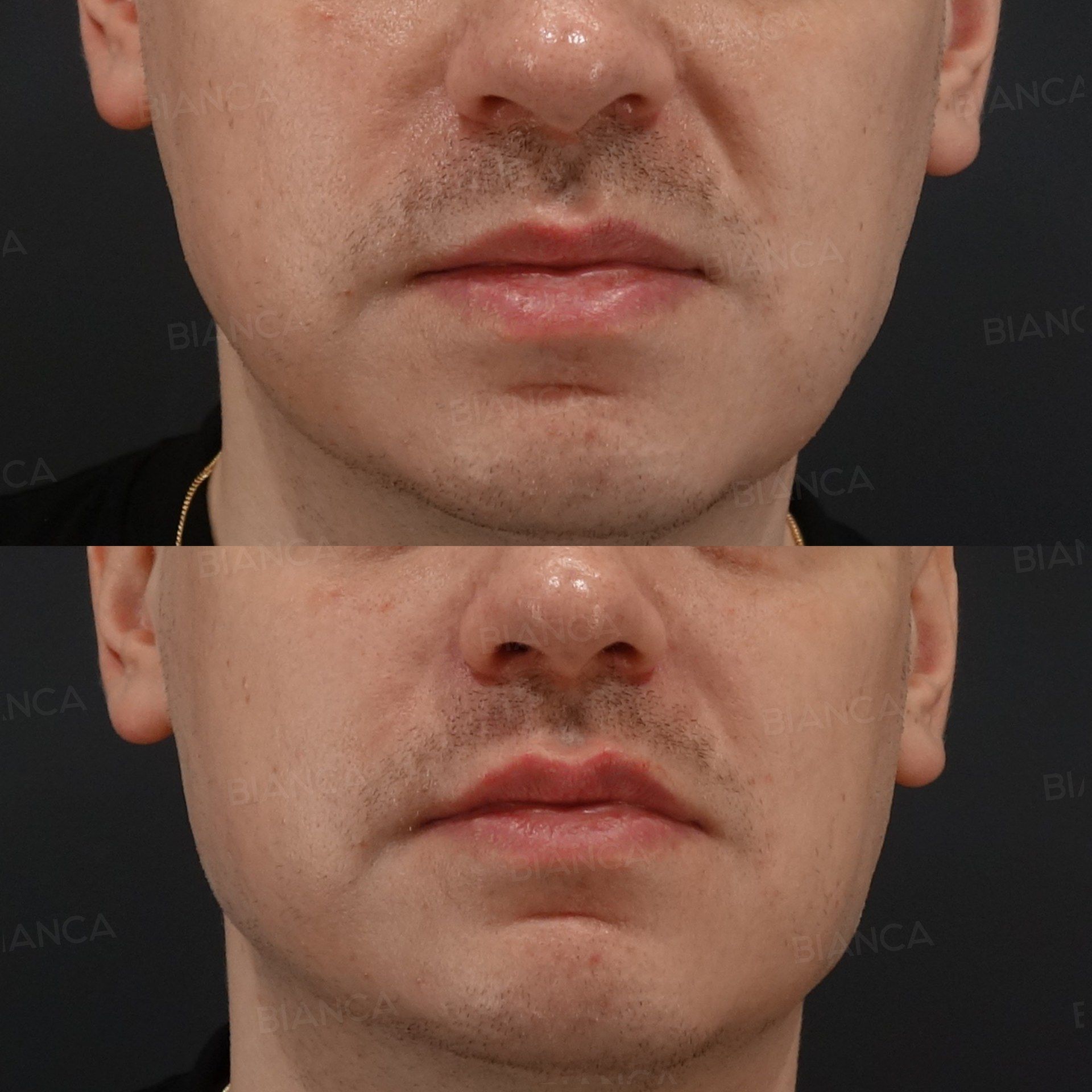 Hyaluronic Acid Filler (Lips and Jawline) before and after, immediately after treatment, BIANCA CLINIC Tokyo