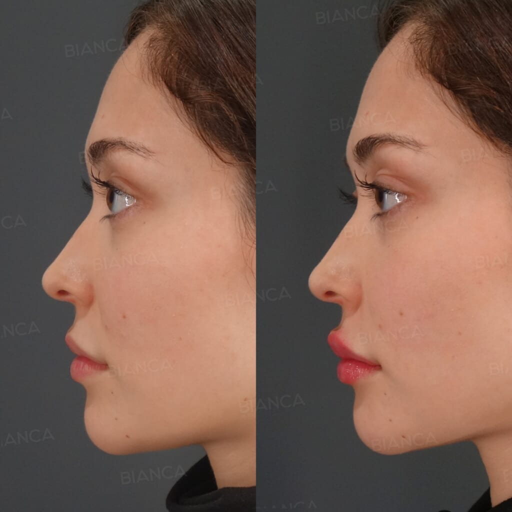 Hyaluronic Acid Filler (Lips) before and after, 1 month, BIANCA CLINIC Tokyo