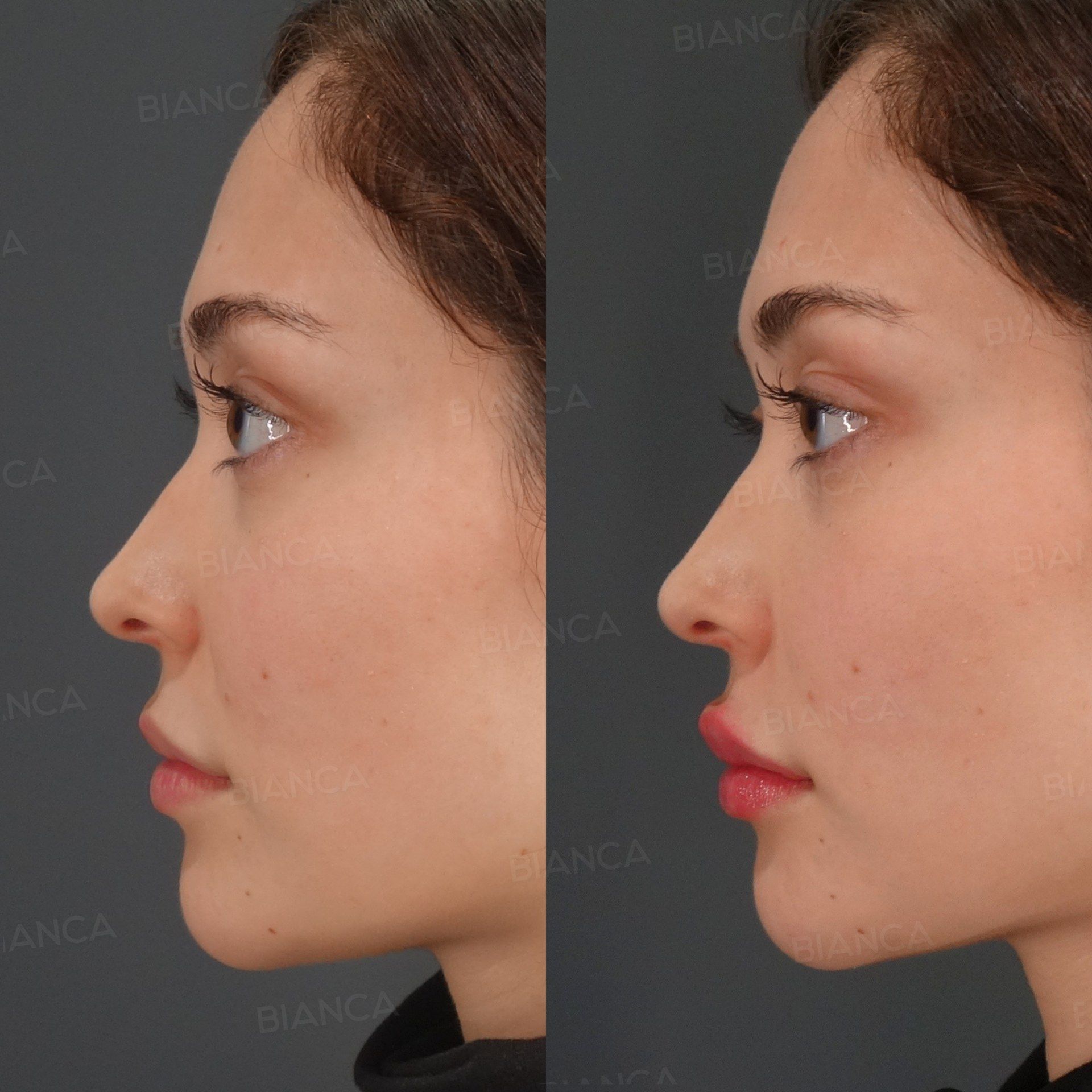 Hyaluronic Acid Filler (Lips) before and after, 1 month, BIANCA CLINIC Tokyo