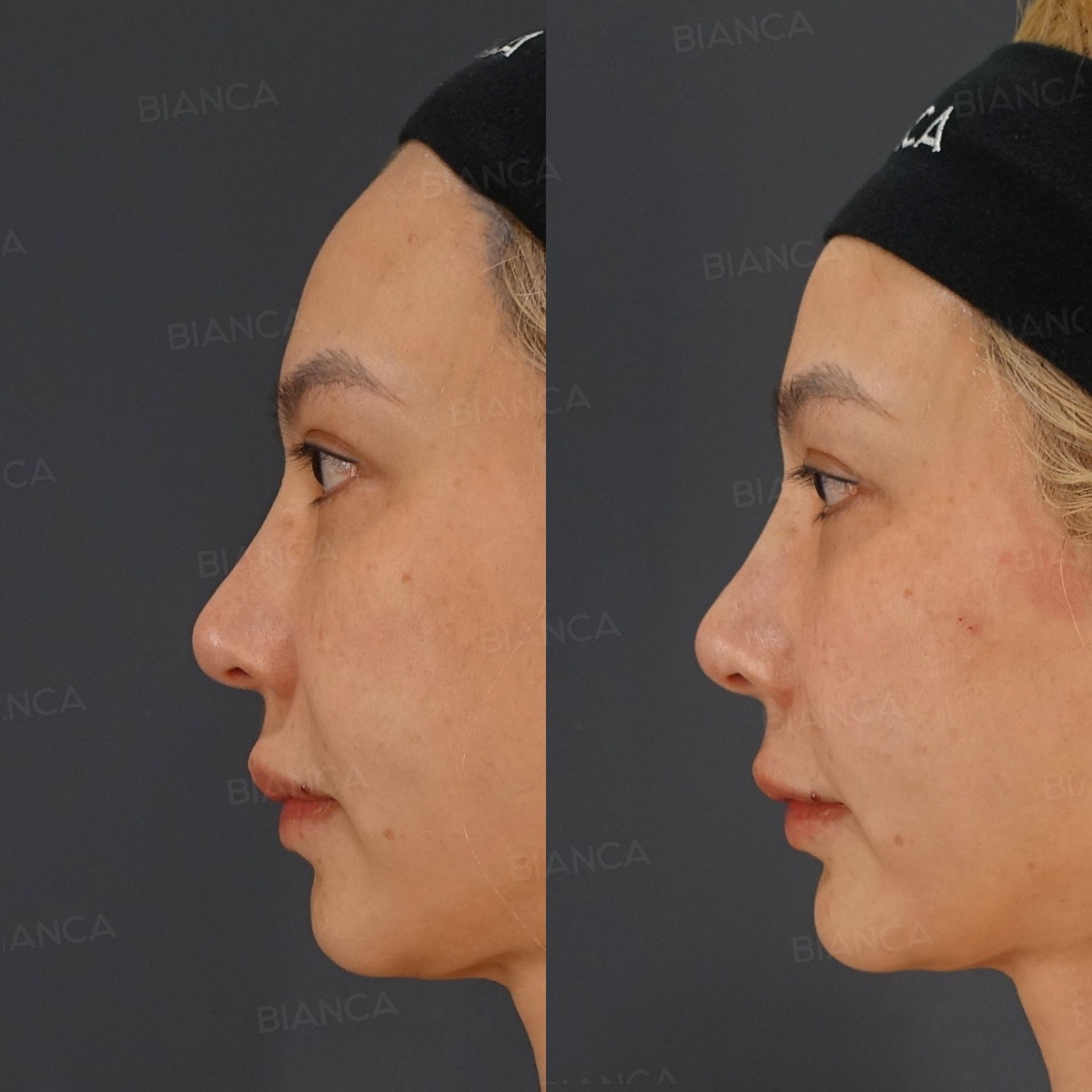 Hyaluronic acid filler before and after facial injection restoring volume and definition, side view immediately after treatment