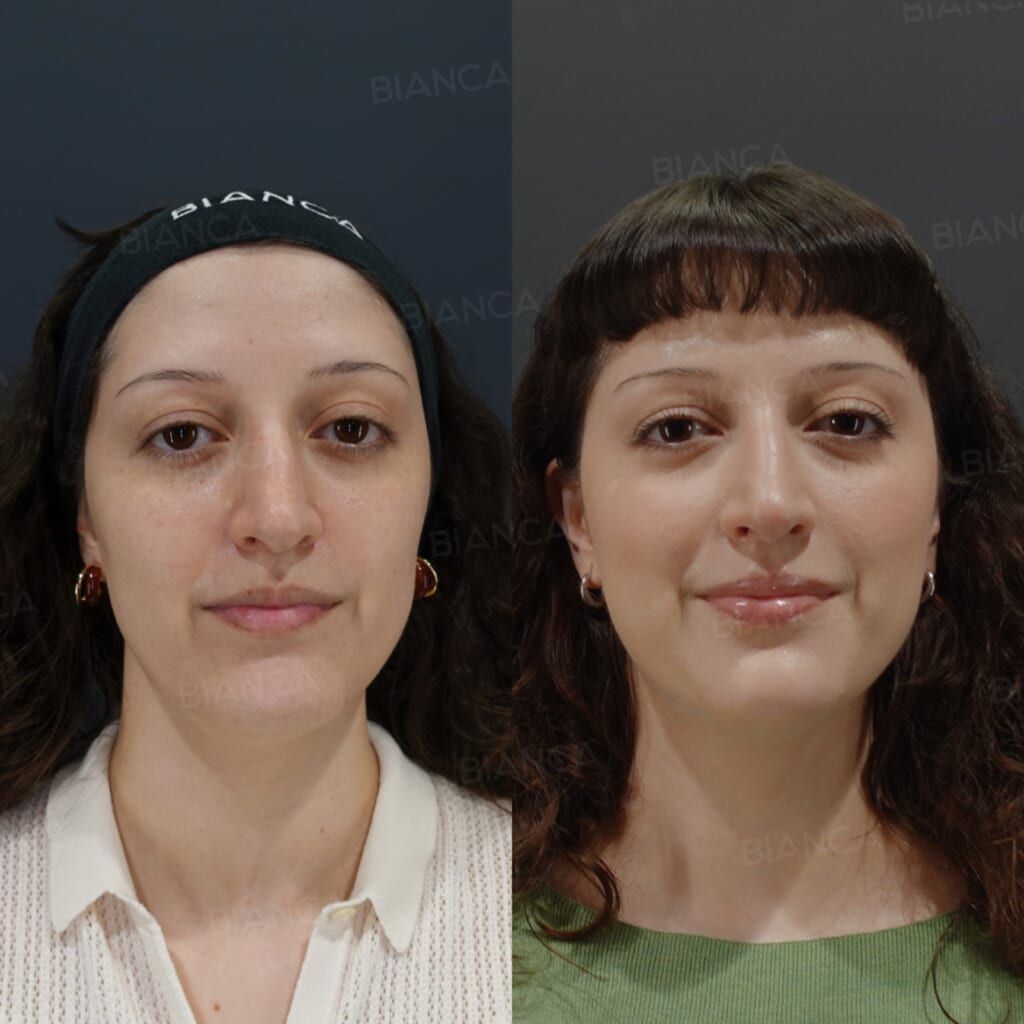 Hyaluronic Acid Injection (Aegyo Sal, Midcheek Groove, Hollow Cheeks, Alar Base, Chin: Juvederm VOLBELLA, Restylane Lido, Juvederm VOLUX, NEAUVIA LV)