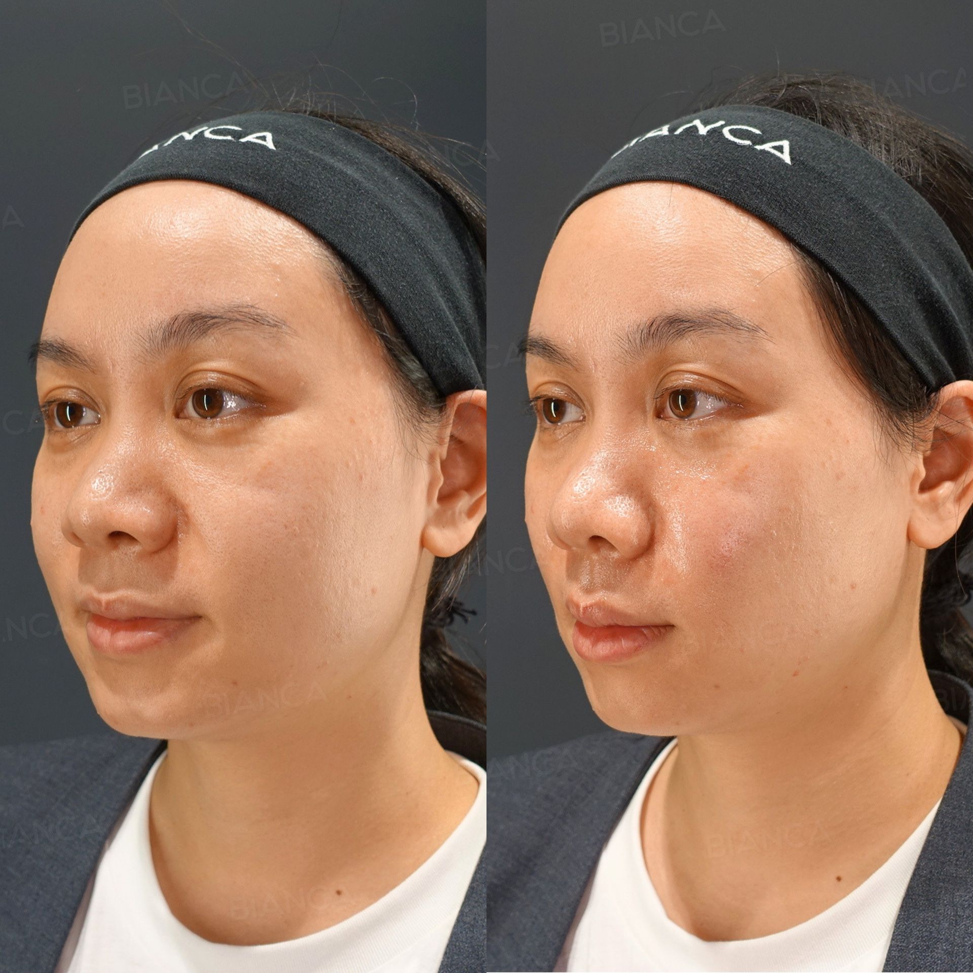 Hyaluronic acid filler before and after treatment of the alar base, nasolabial folds and midcheek groove, three-quarter view, immediately after treatment