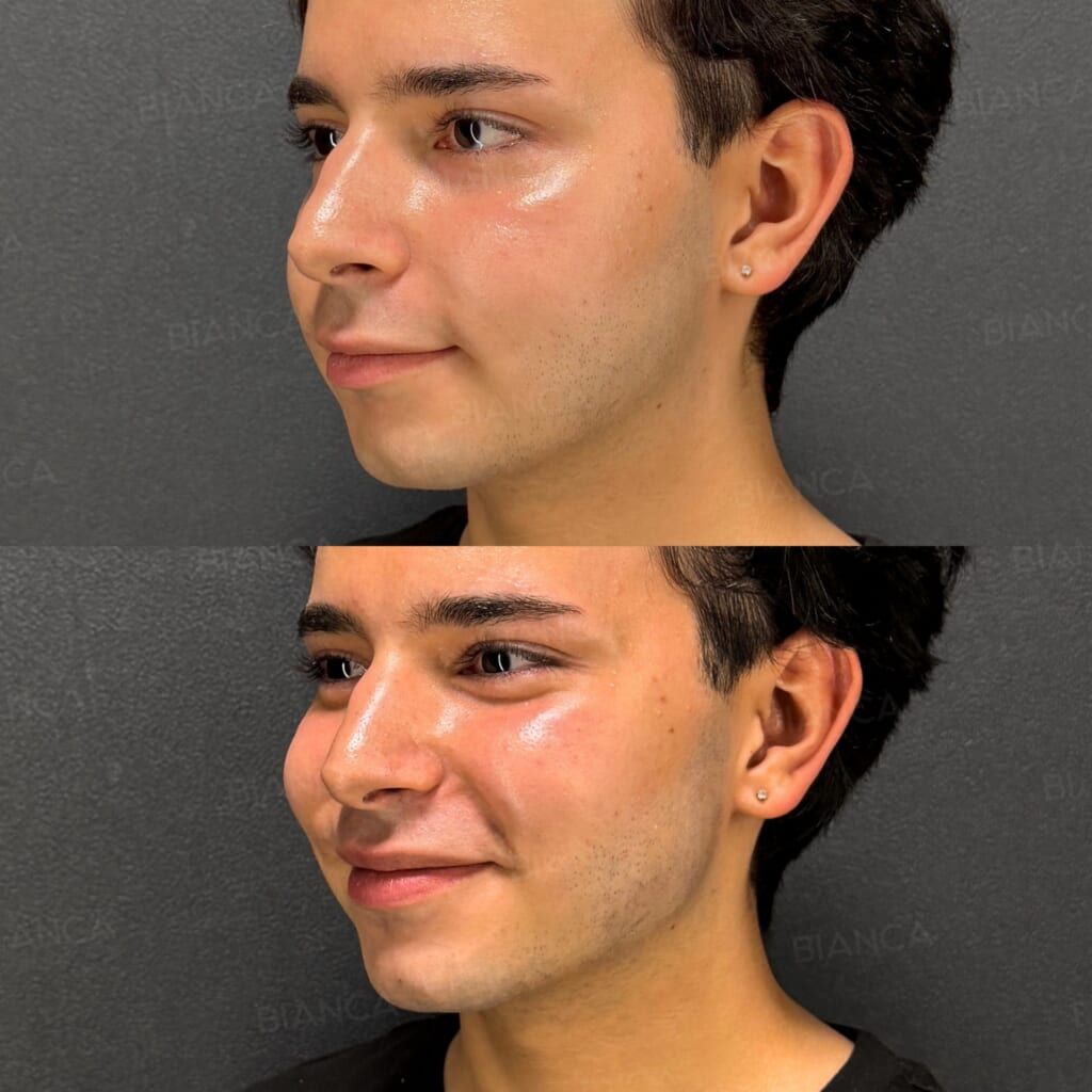 Hyaluronic Acid Injection (Chin, Jawline)