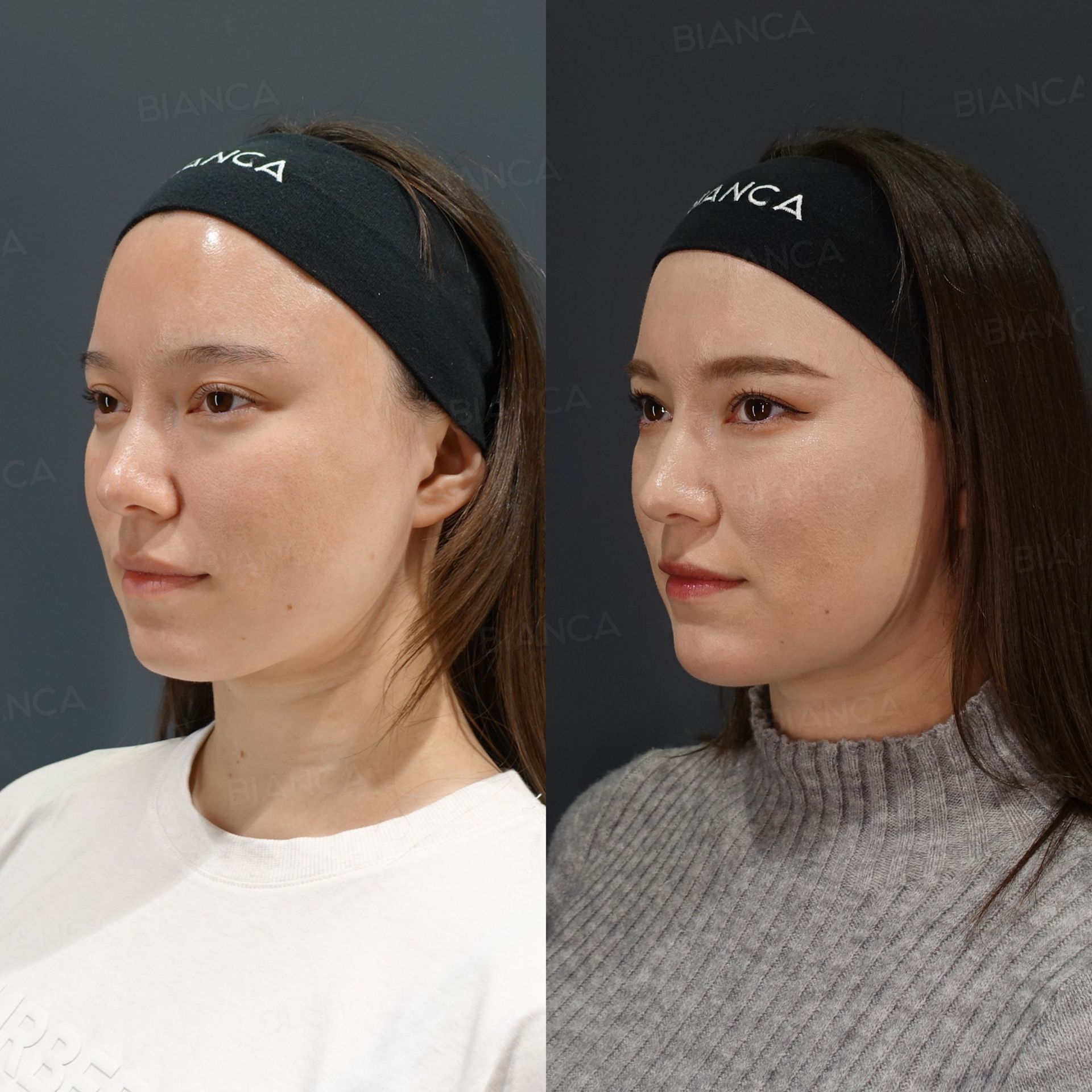Hyaluronic Acid Injection (Chin: Juvederm VOLUX), Baby Collagen (Under Eyes), Botox Injection (Temporalis, Jaw Angle, Chin, Neck: Allergan)