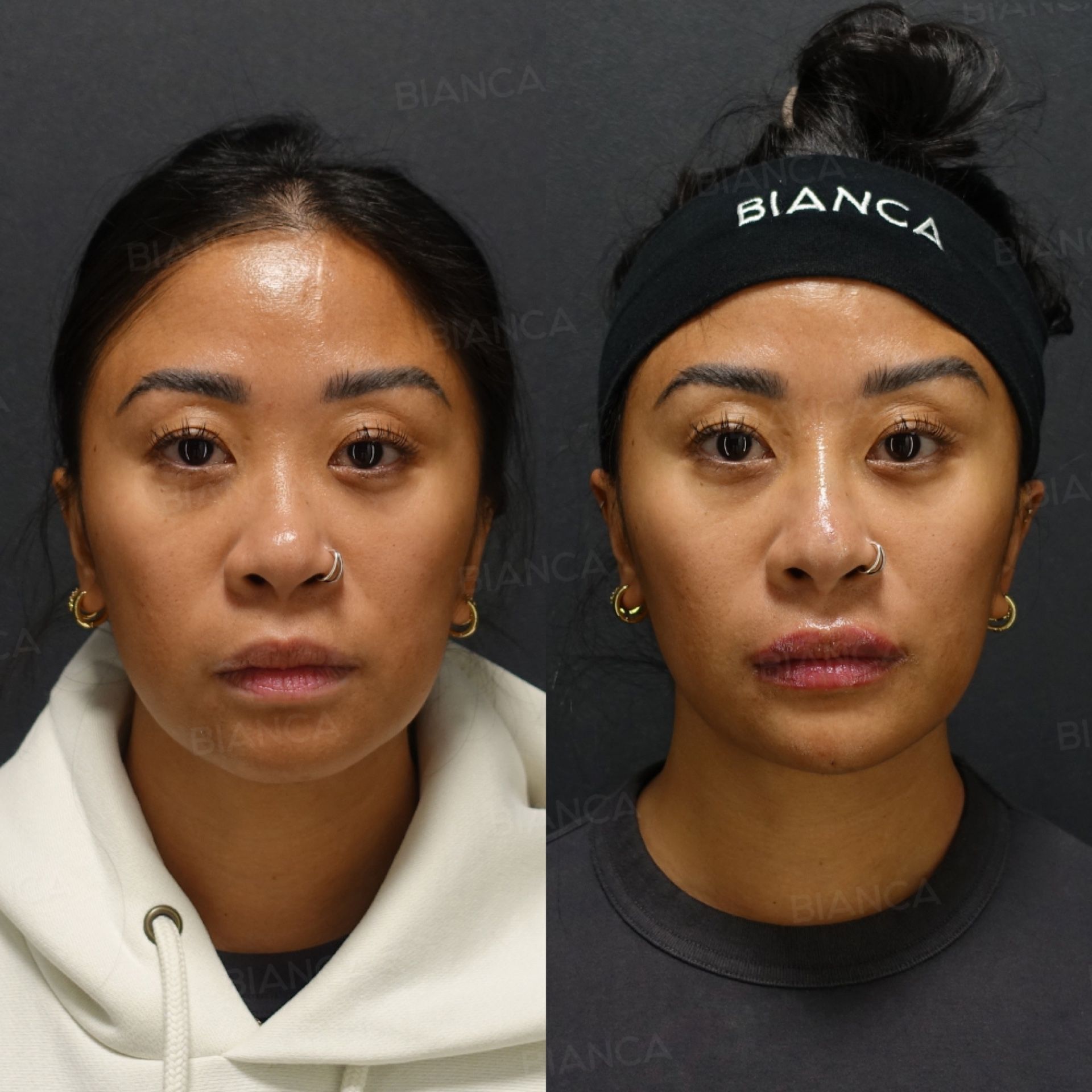 Hyaluronic acid filler before and after treatment of the chin, nose tip and lips with NEAUVIA INTENSE and NEAUVIA FLUX, front view, immediately after treatment