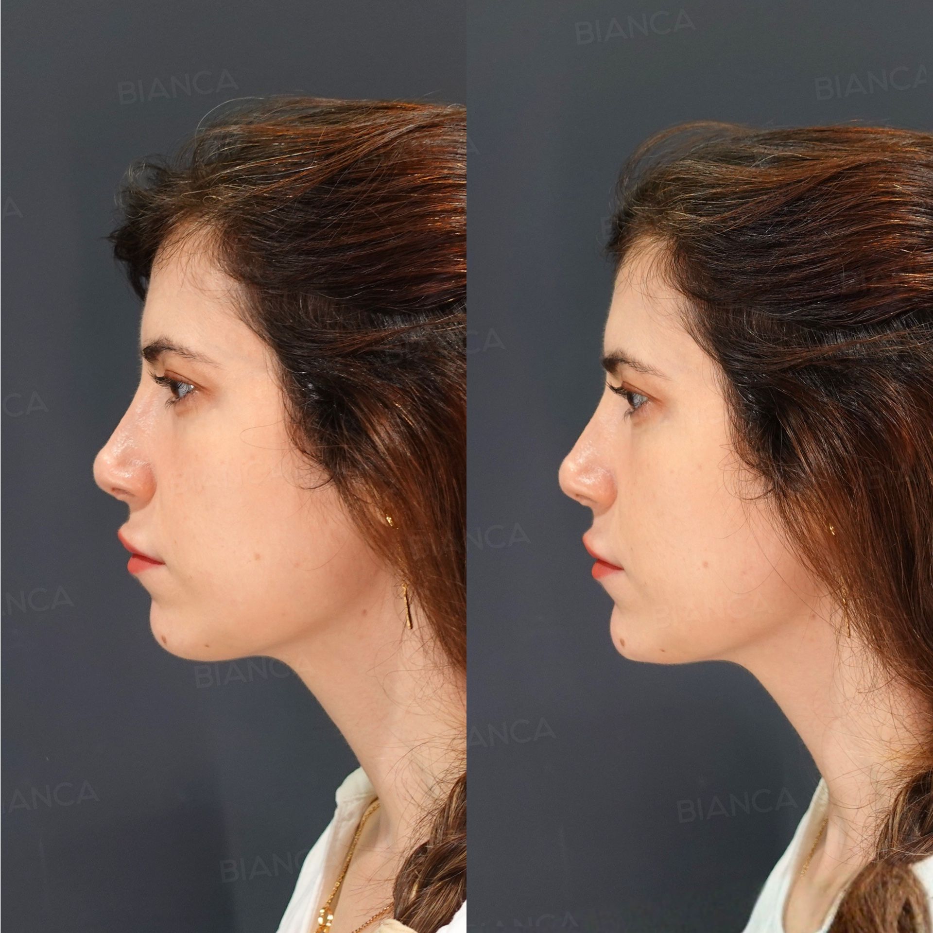 Hyaluronic acid filler before and after Restylane Lyft injection to the chin, side view, immediately after treatment