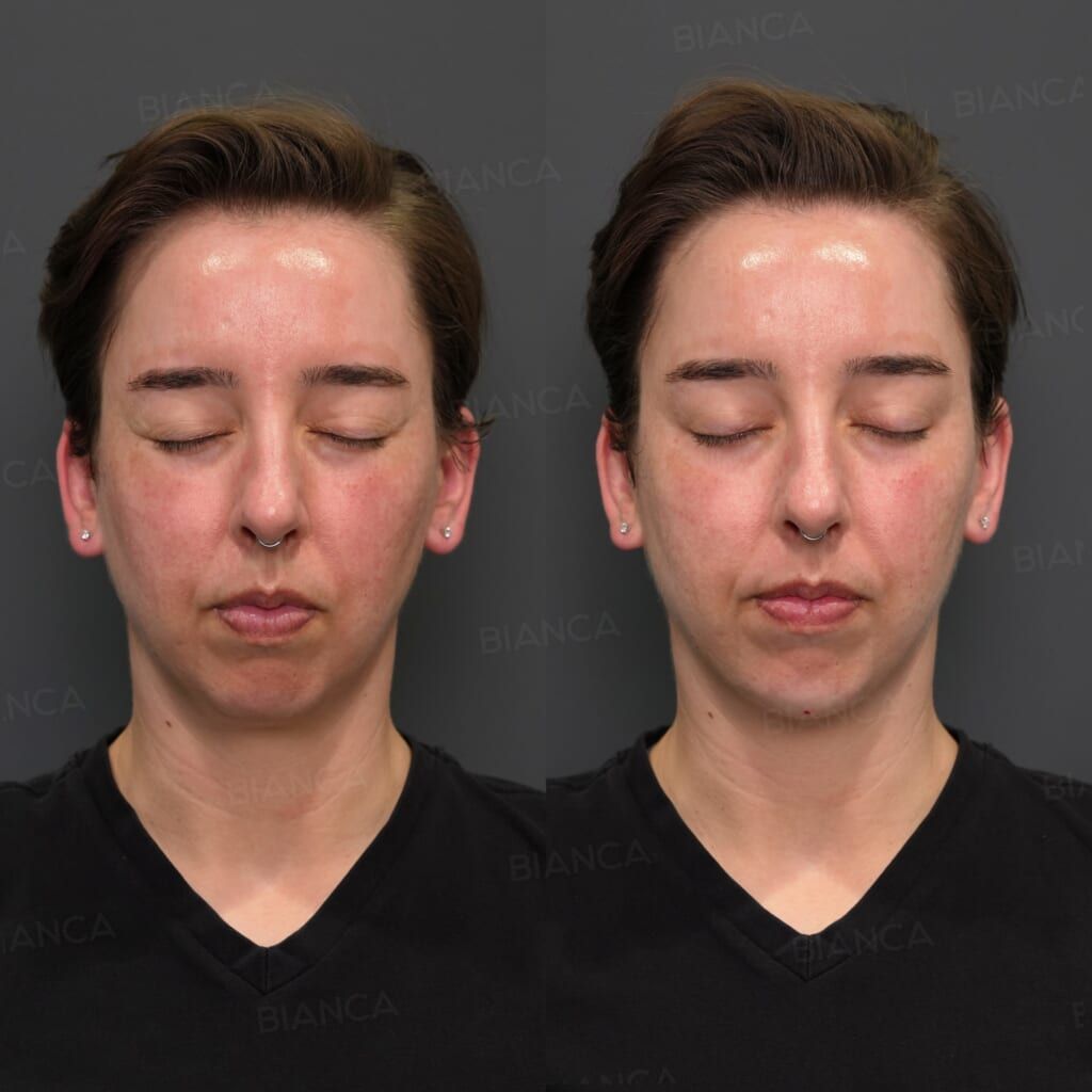 Hyaluronic Acid Injection (Chin: Restylane Lyft)