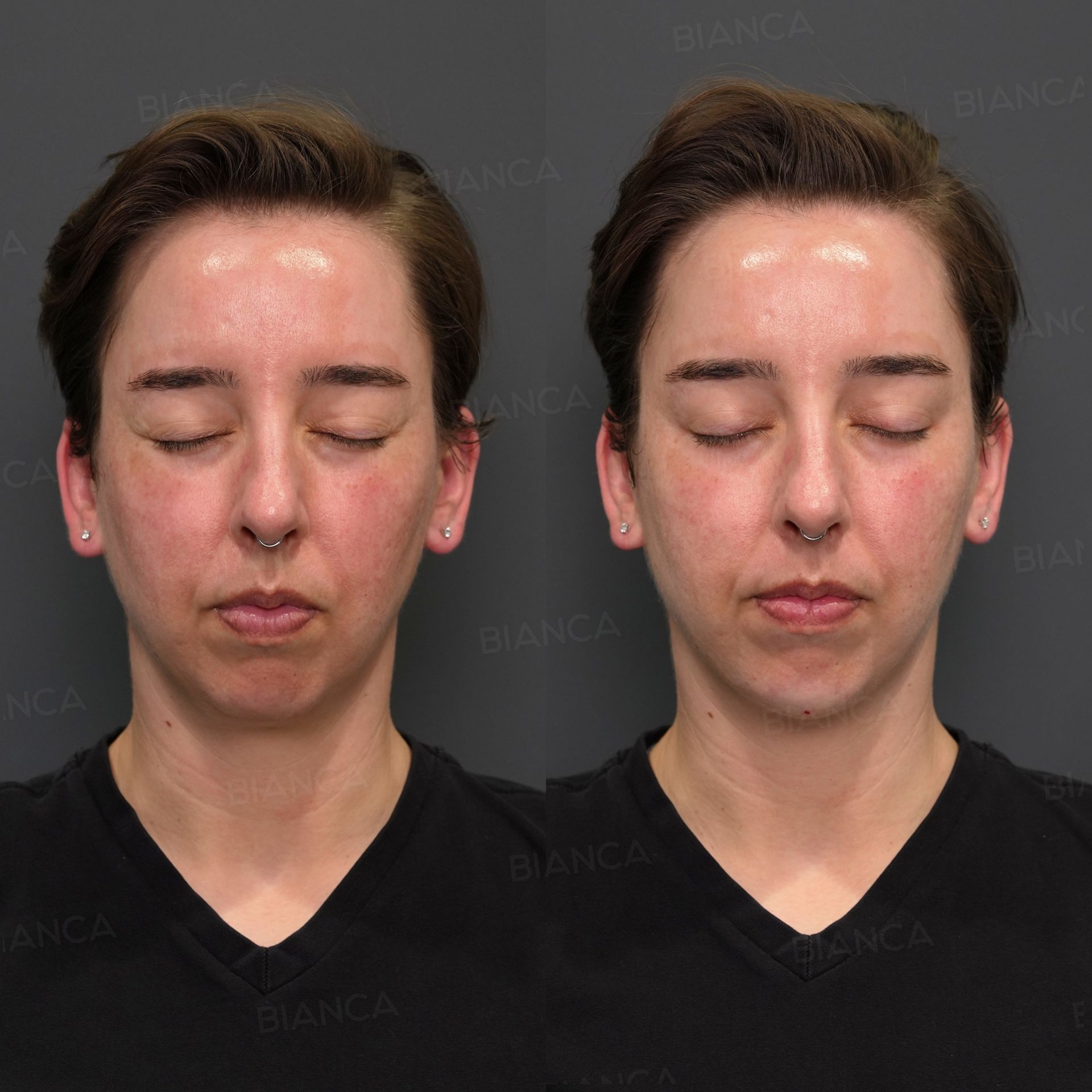 Hyaluronic acid chin filler before and after Restylane Lyft placed on the bone of a recessed chin, front view, immediately after treatment