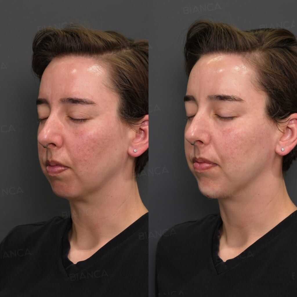 Hyaluronic Acid Injection (Chin: Restylane Lyft)