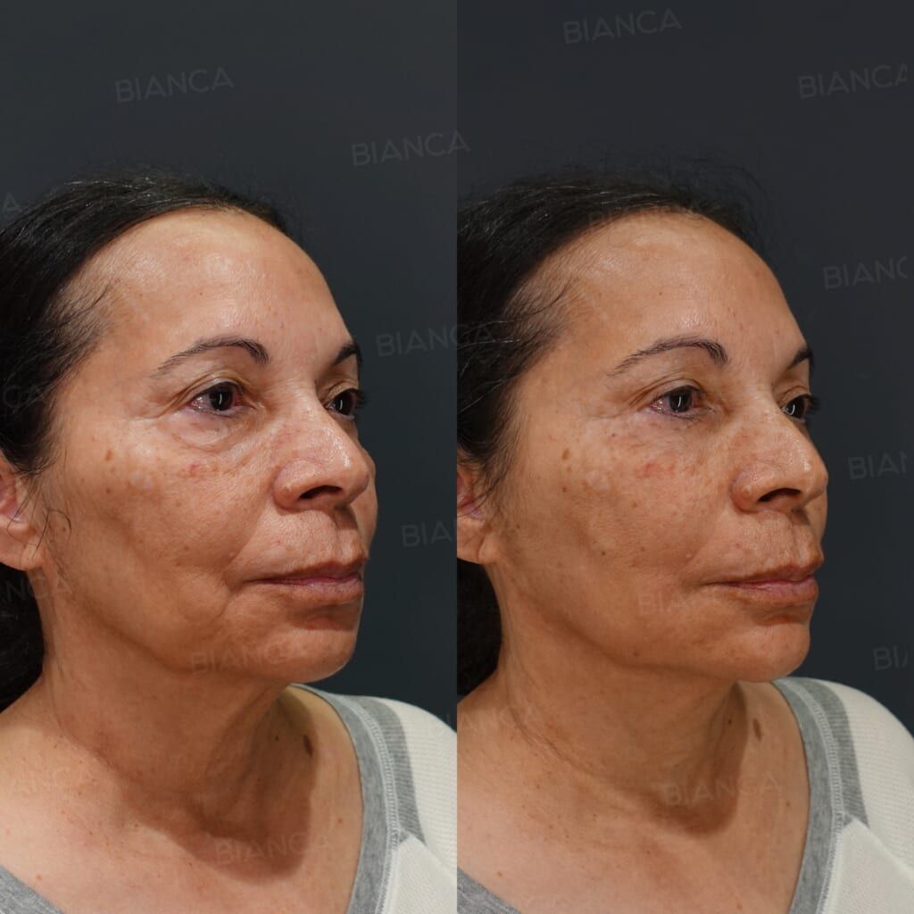 Hyaluronic Acid Injection (Hollow Cheeks, Nasolabial Folds, Marionette Lines, Jawline: Restylane Lyft, Teosyal RHA 3, Teosyal RHA 2, NEAUVIA INTENSE), Baby Collagen (Under Eyes)