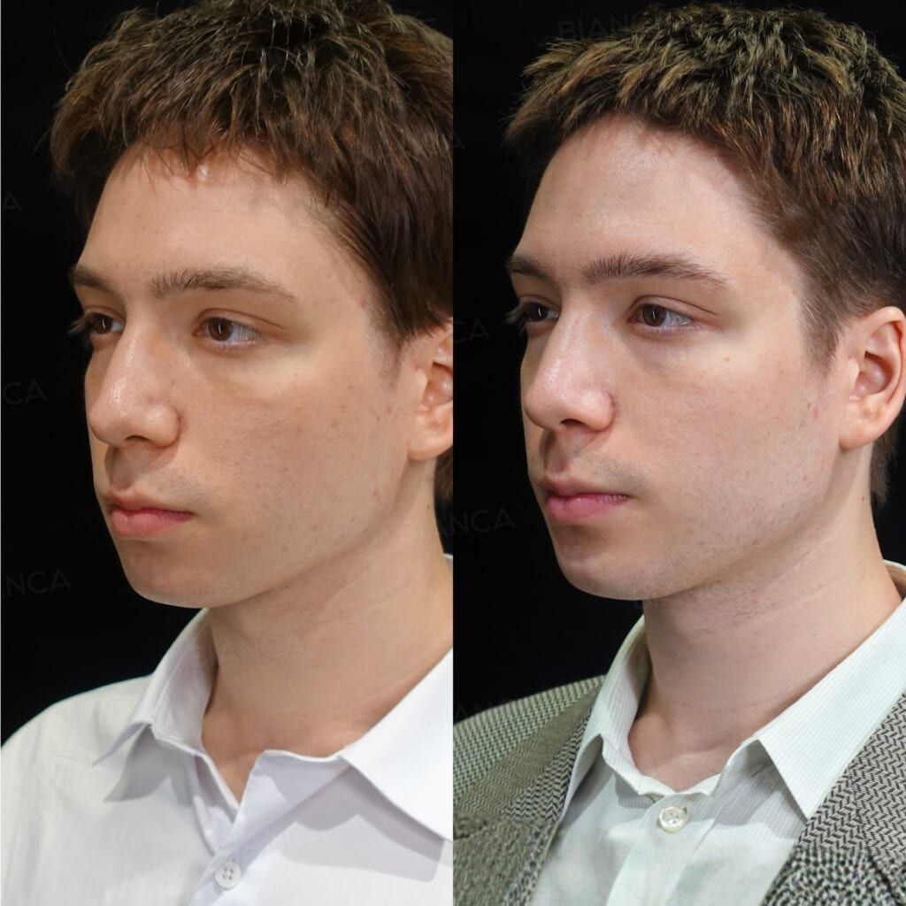 Hyaluronic Acid Injection (Lips, Chin, Jaw Angle: Juvederm VOLBELLA, Juvederm VOLUX)