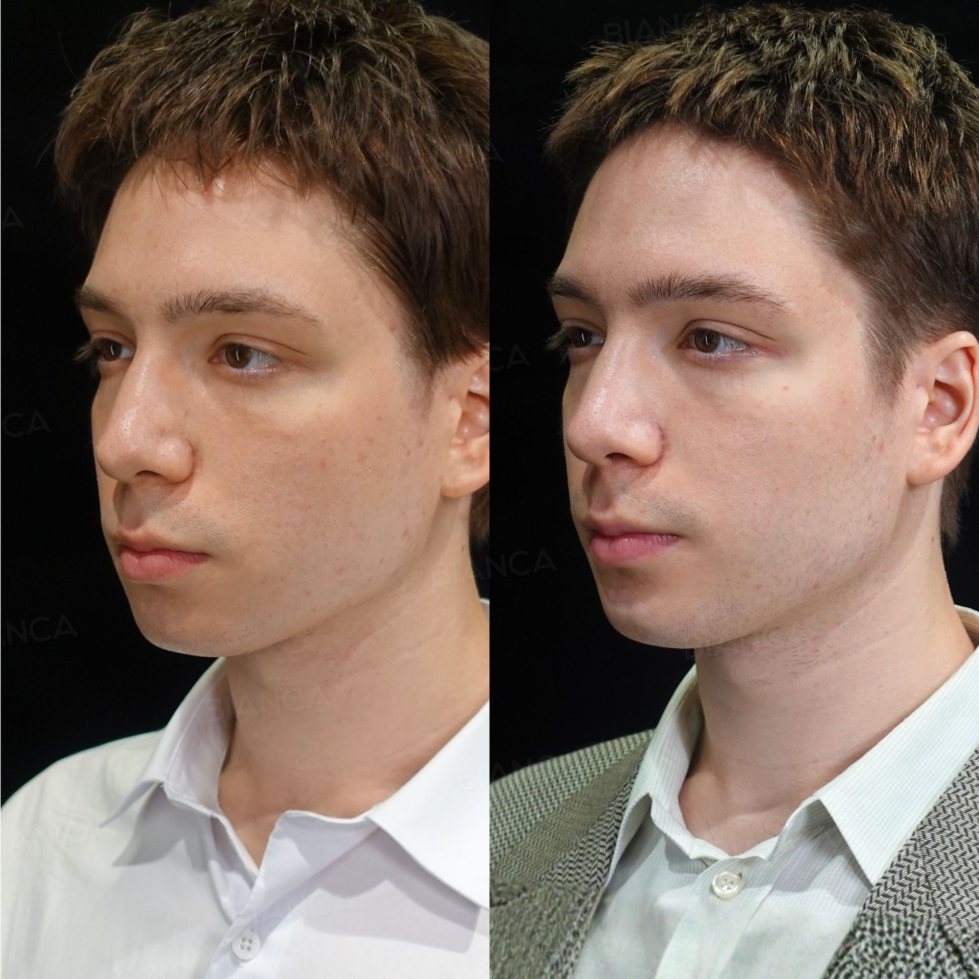 Hyaluronic acid filler before and after lip, chin and jaw angle treatment with Juvederm VOLBELLA and VOLUX, three-quarter view immediately after treatment