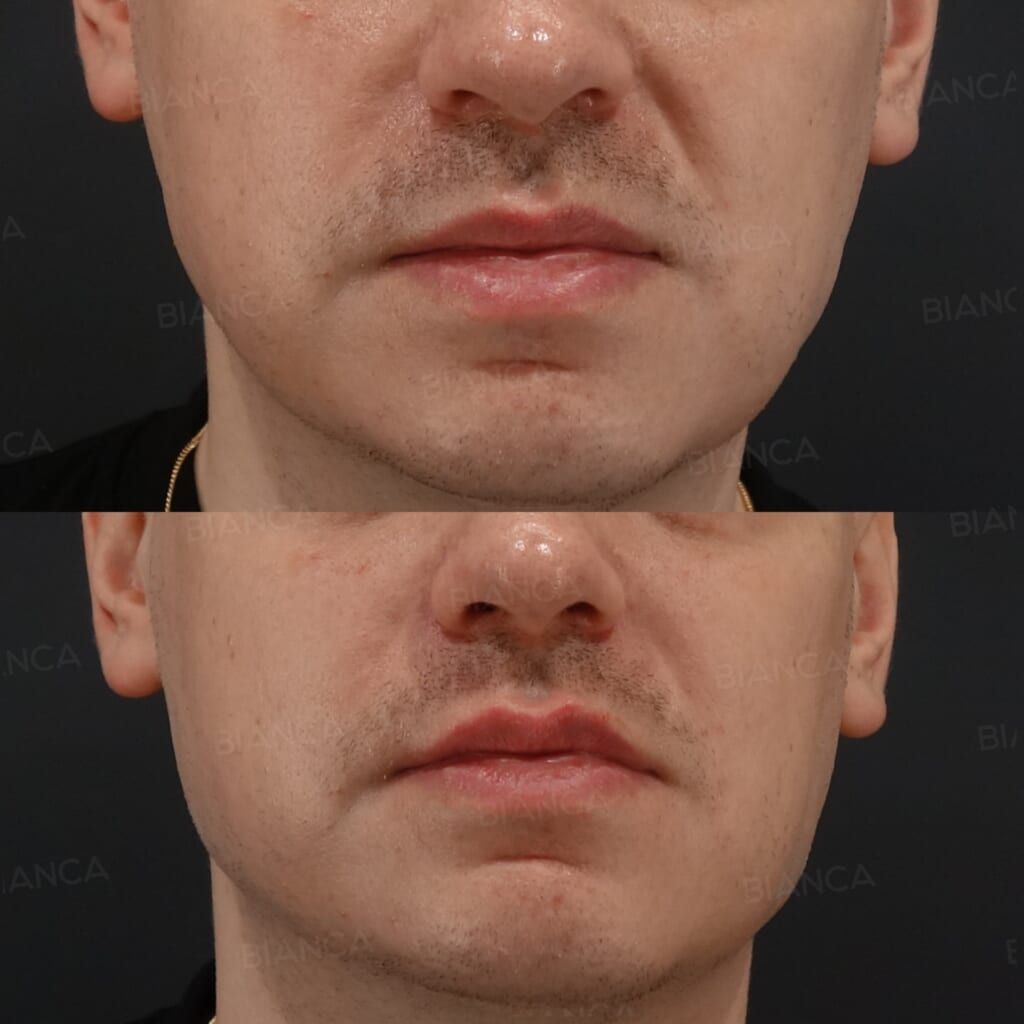 Hyaluronic Acid Injection (Lips, Jawline: Juvederm VOLBELLA, Restylane Lyft)