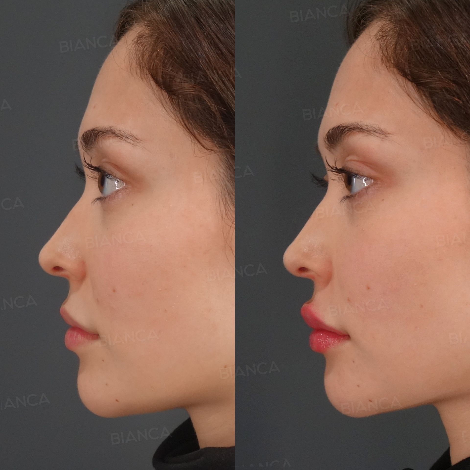 Hyaluronic Acid Injection (Lips: Juvederm VOLBELLA)