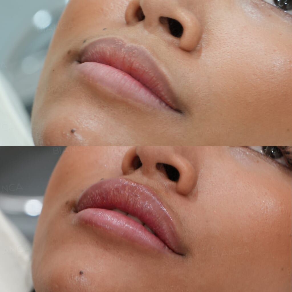 Hyaluronic Acid Injection (Lips: Juvederm VOLBELLA)