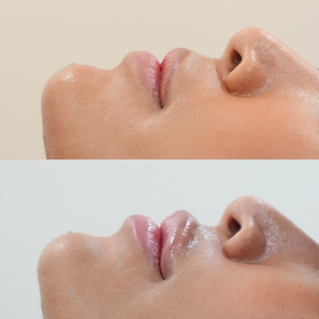 Hyaluronic Acid Injection (Lips: Juvederm VOLBELLA)