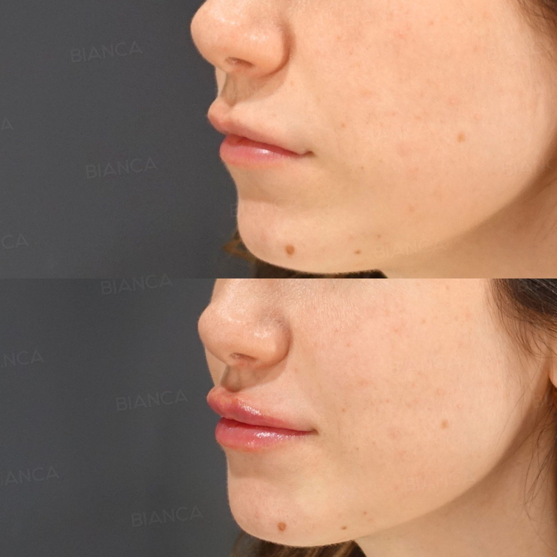 Hyaluronic acid lip filler before and after Juvederm VOLBELLA injection keeping the upper and lower lip balance, three-quarter view at 2 weeks