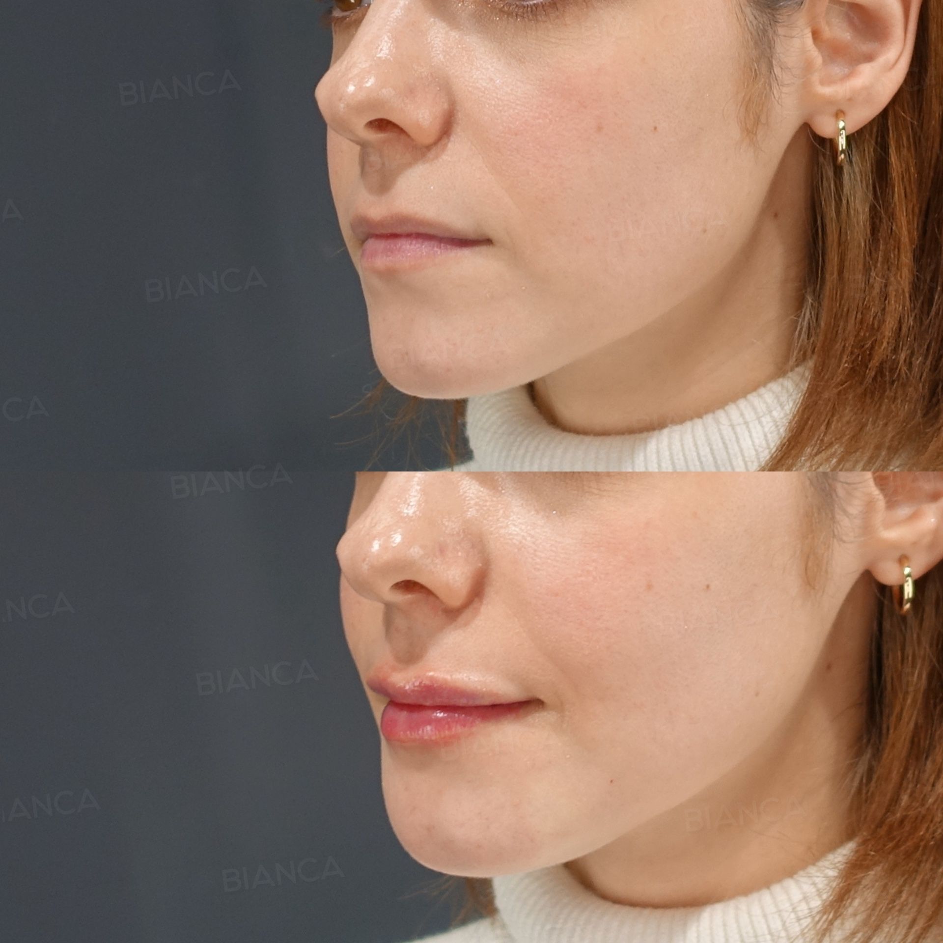 Hyaluronic acid lip filler before and after a repeat session with Juvederm VOLBELLA, three-quarter view, at 2 weeks