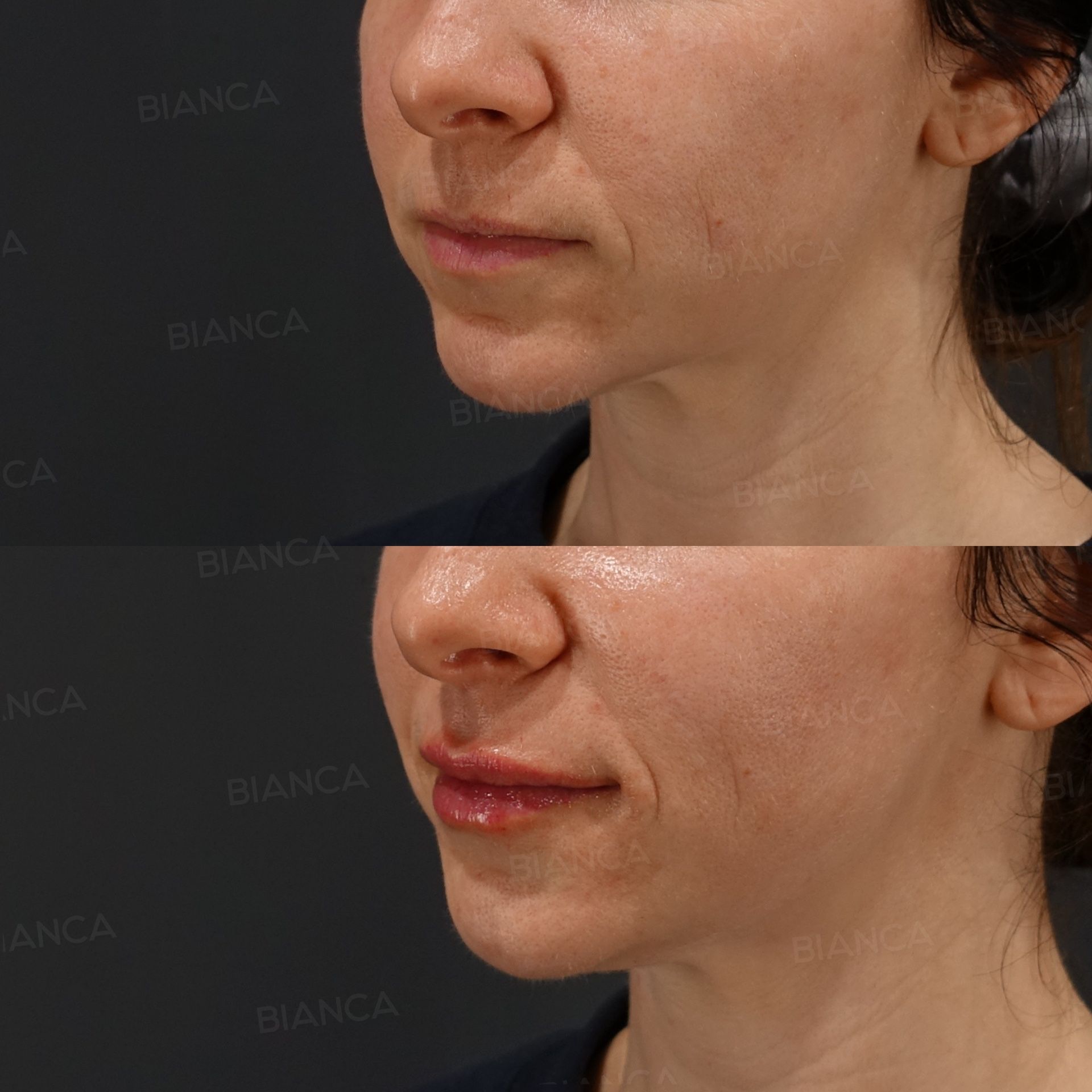 Hyaluronic acid filler before and after lip augmentation with Juvederm VOLBELLA, three-quarter view, immediately after treatment