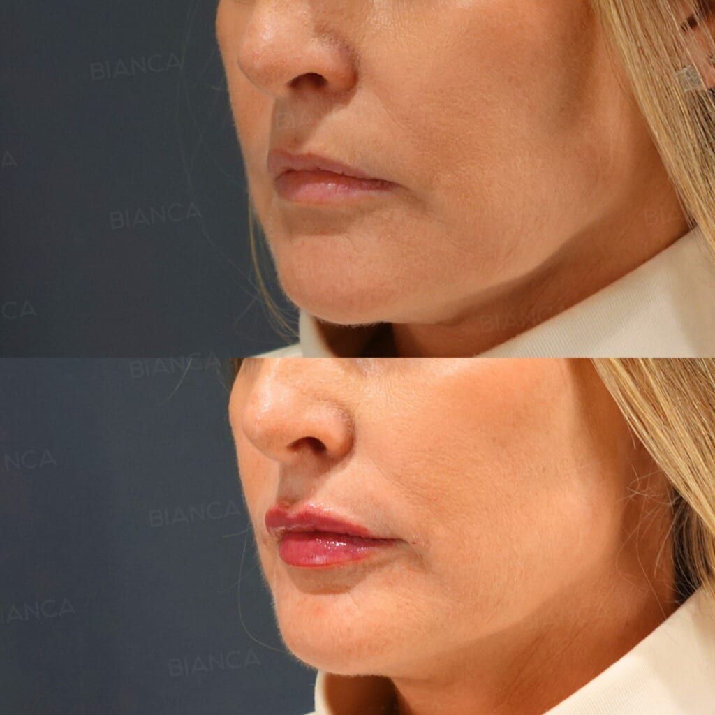 Hyaluronic Acid Injection (Lips: Juvederm VOLBELLA)