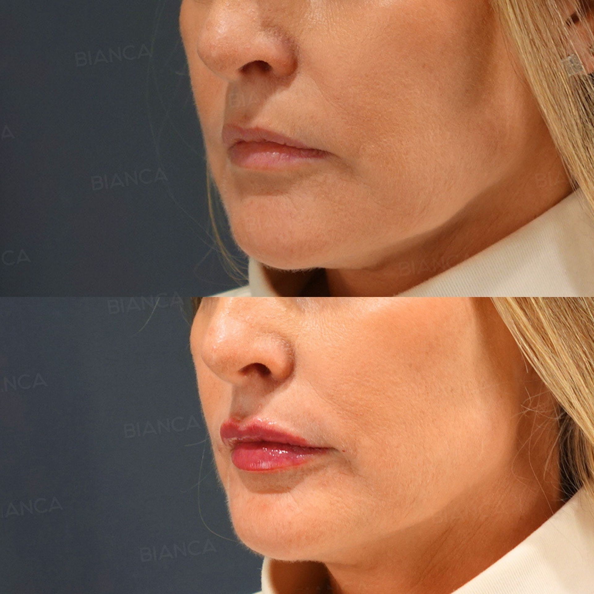 Hyaluronic Acid Injection (Lips: Juvederm VOLBELLA)