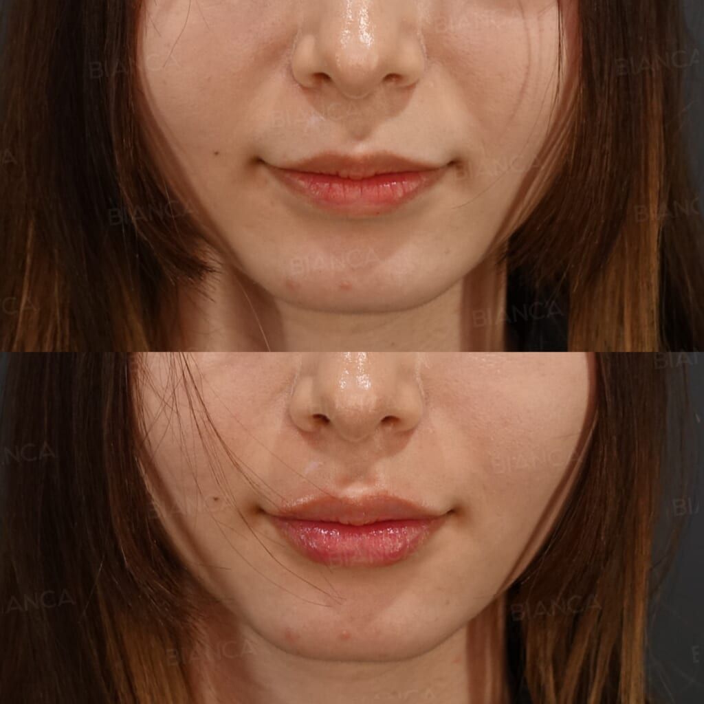 Hyaluronic Acid Injection (Lips: Juvederm VOLBELLA)