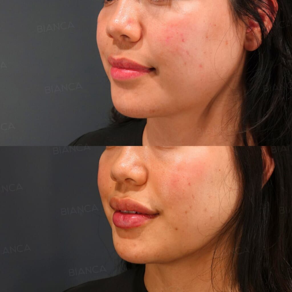 Hyaluronic Acid Injection (Lips: Juvederm VOLIFT)