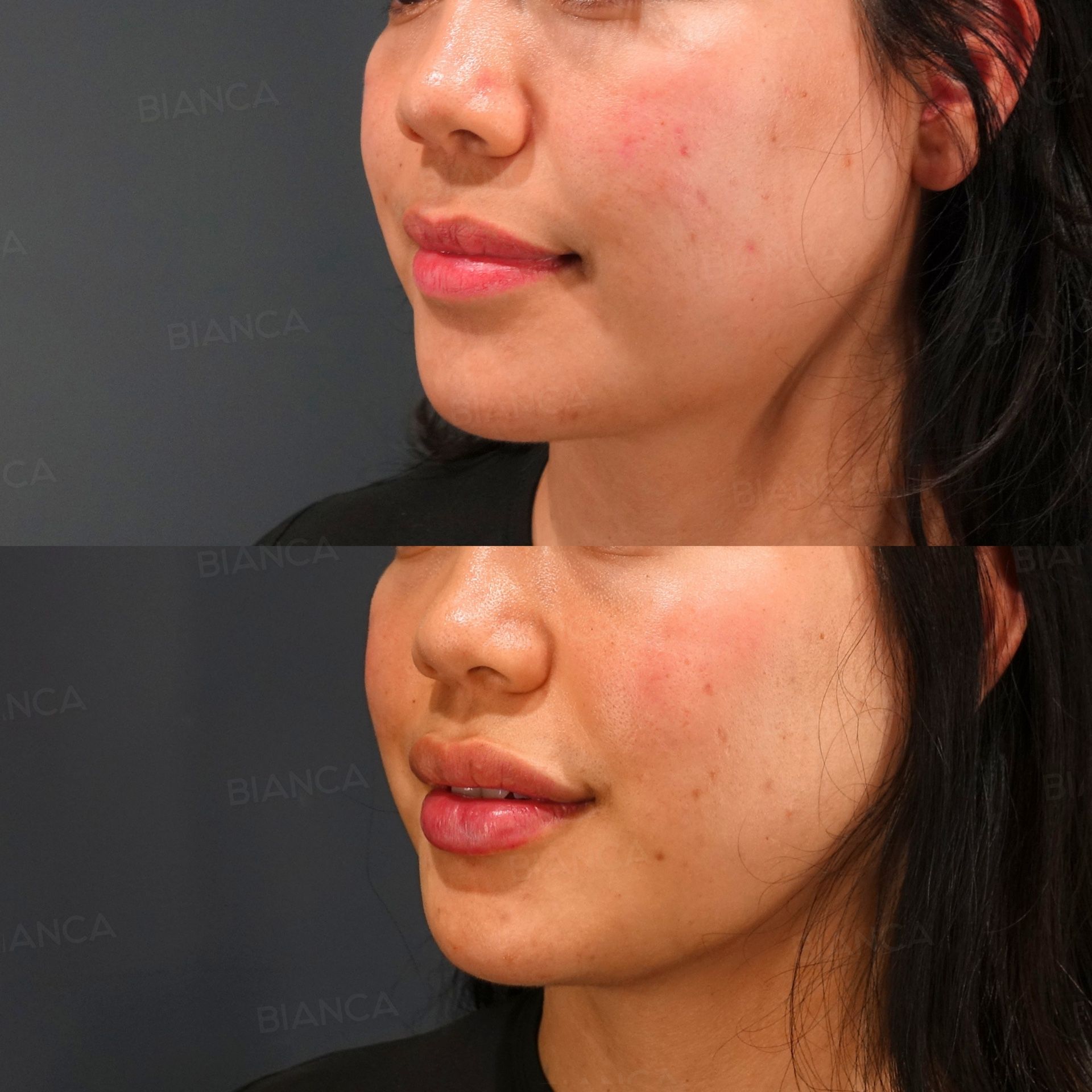 Hyaluronic Acid Injection (Lips: Juvederm VOLIFT)