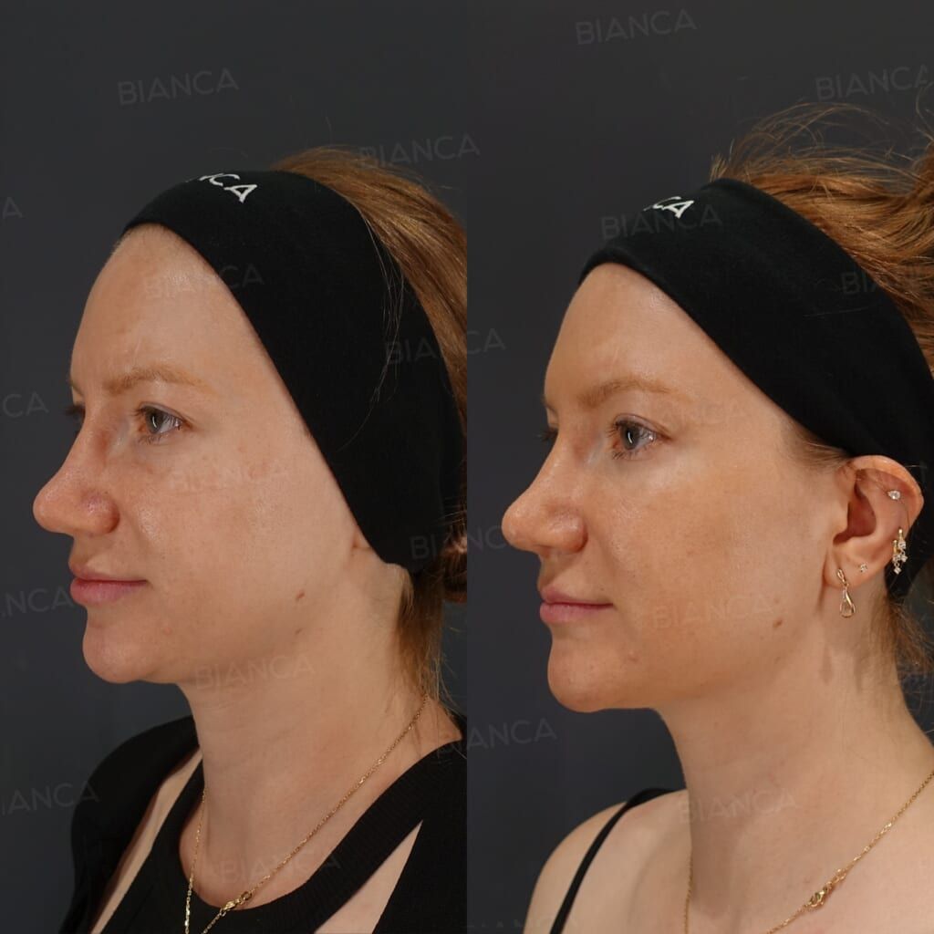 Hyaluronic Acid Injection (Lips, Nasolabial Folds, Jawline, Chin: NEAUVIA FLUX, NEAUVIA RHEOLOGY, NEAUVIA INTENSE)