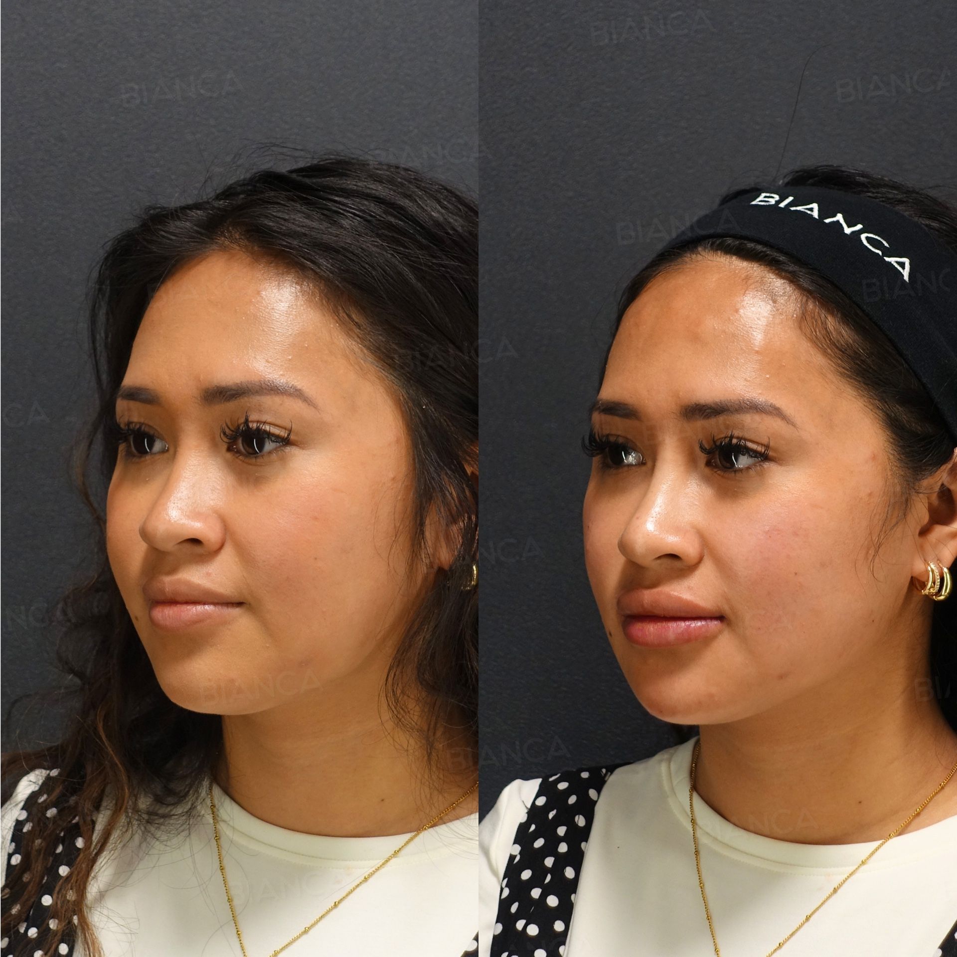 Hyaluronic acid filler before and after lip, nasolabial fold, nose tip and chin injection with NEAUVIA, three-quarter view, immediately after treatment