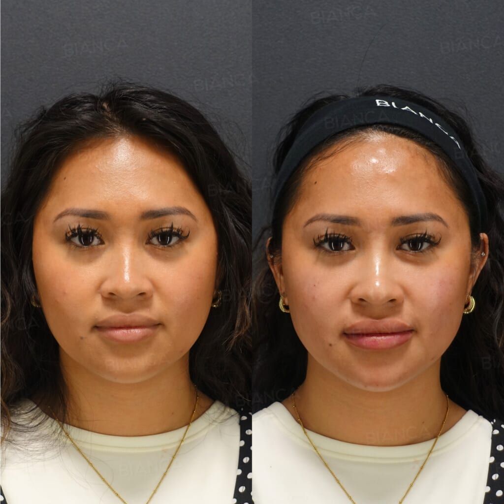 Hyaluronic Acid Injection (Lips, Nasolabial Folds, Nose Tip, Chin: NEAUVIA FLUX, NEAUVIA INTENSE)