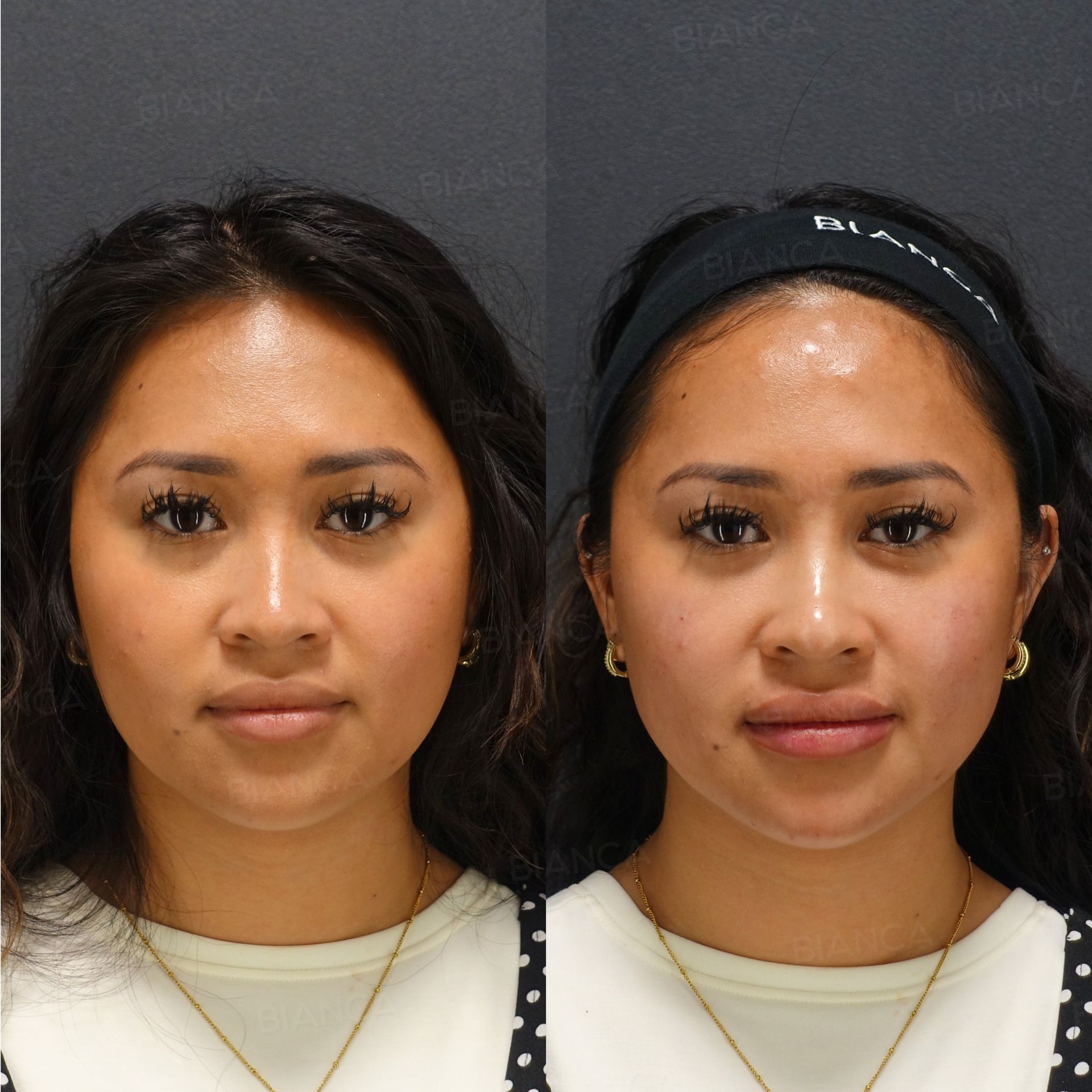 Hyaluronic acid filler before and after NEAUVIA FLUX and INTENSE in the lips, nasolabial folds, nose tip and chin, front view, immediately after treatment