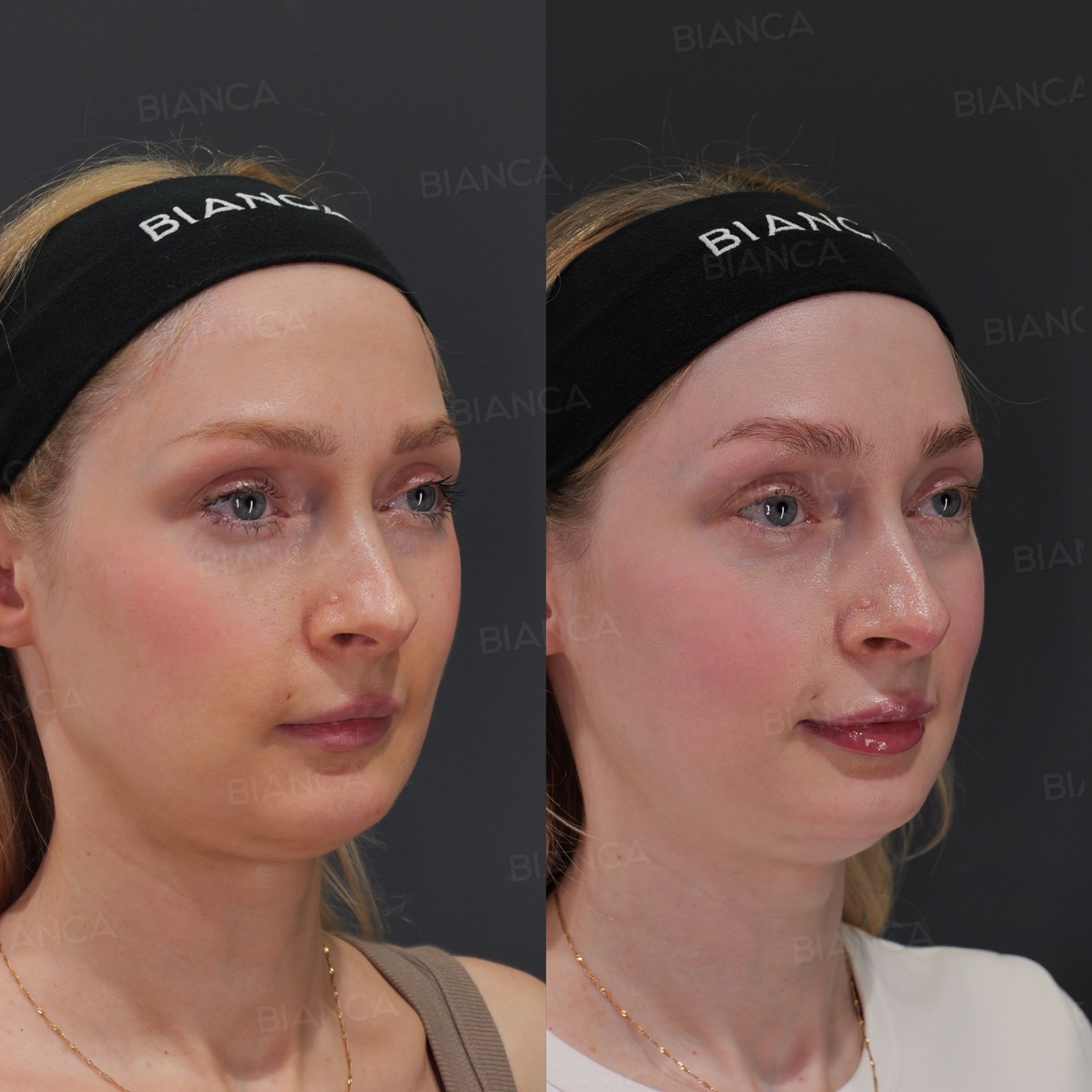 Lip filler before and after NEAUVIA RHEOLOGY hyaluronic acid injection shaped to the existing lip border, three-quarter view at 1 week