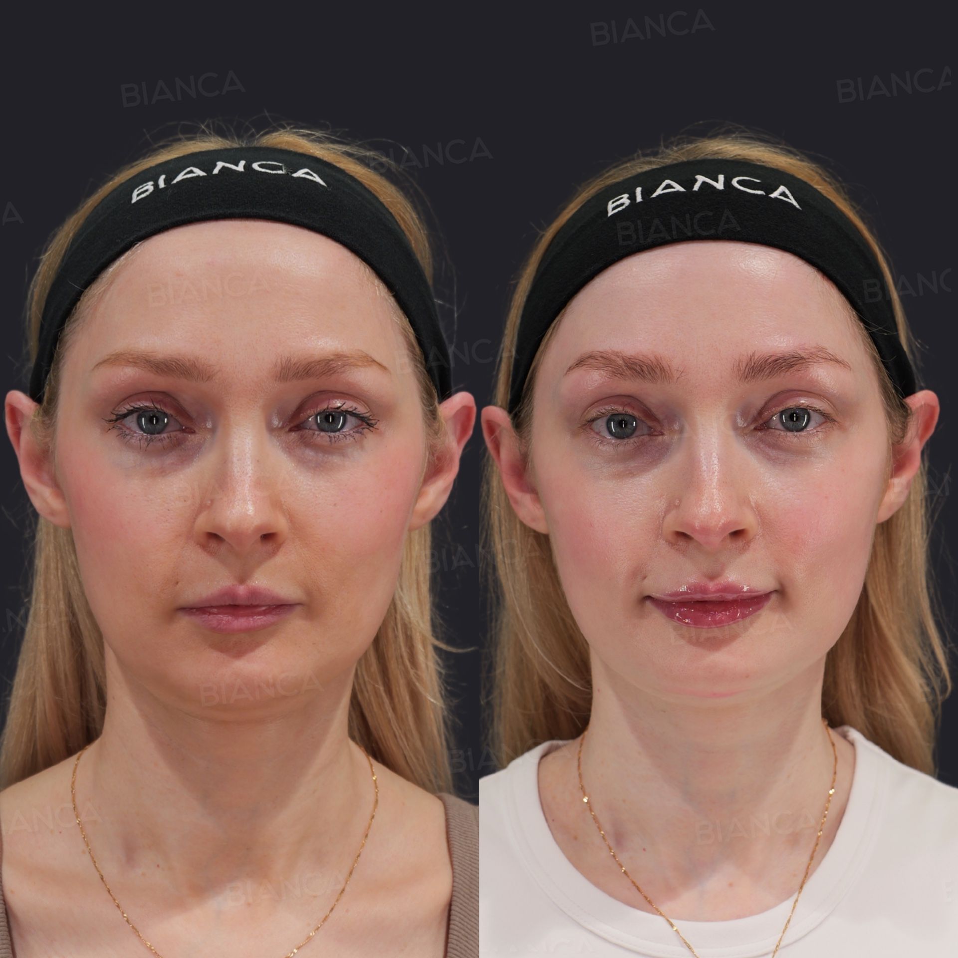 Hyaluronic acid lip filler before and after NEAUVIA RHEOLOGY injection to add fullness to the lips, front view at 1 week