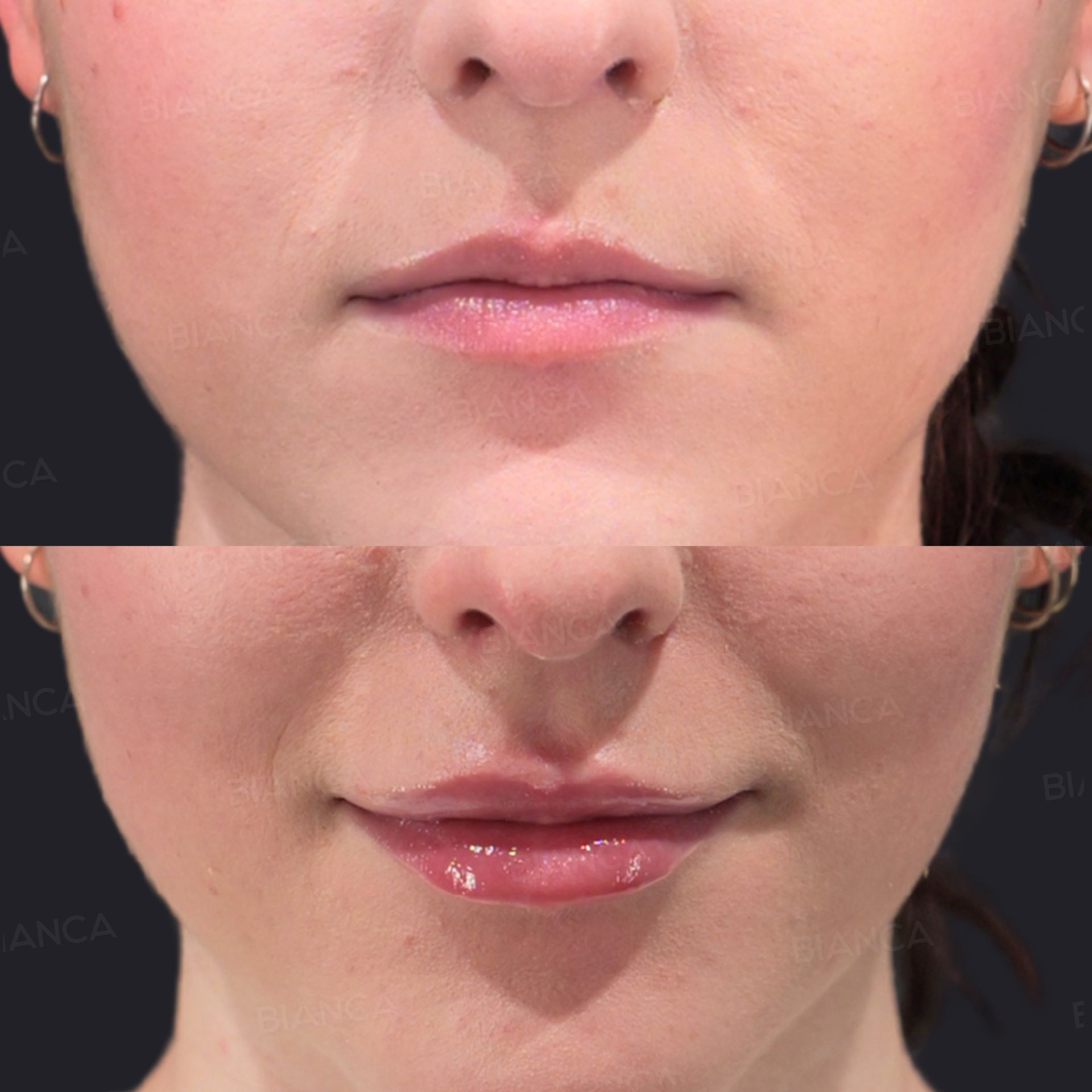 Hyaluronic Acid Injection (Lips: NEAUVIA RHEOLOGY)