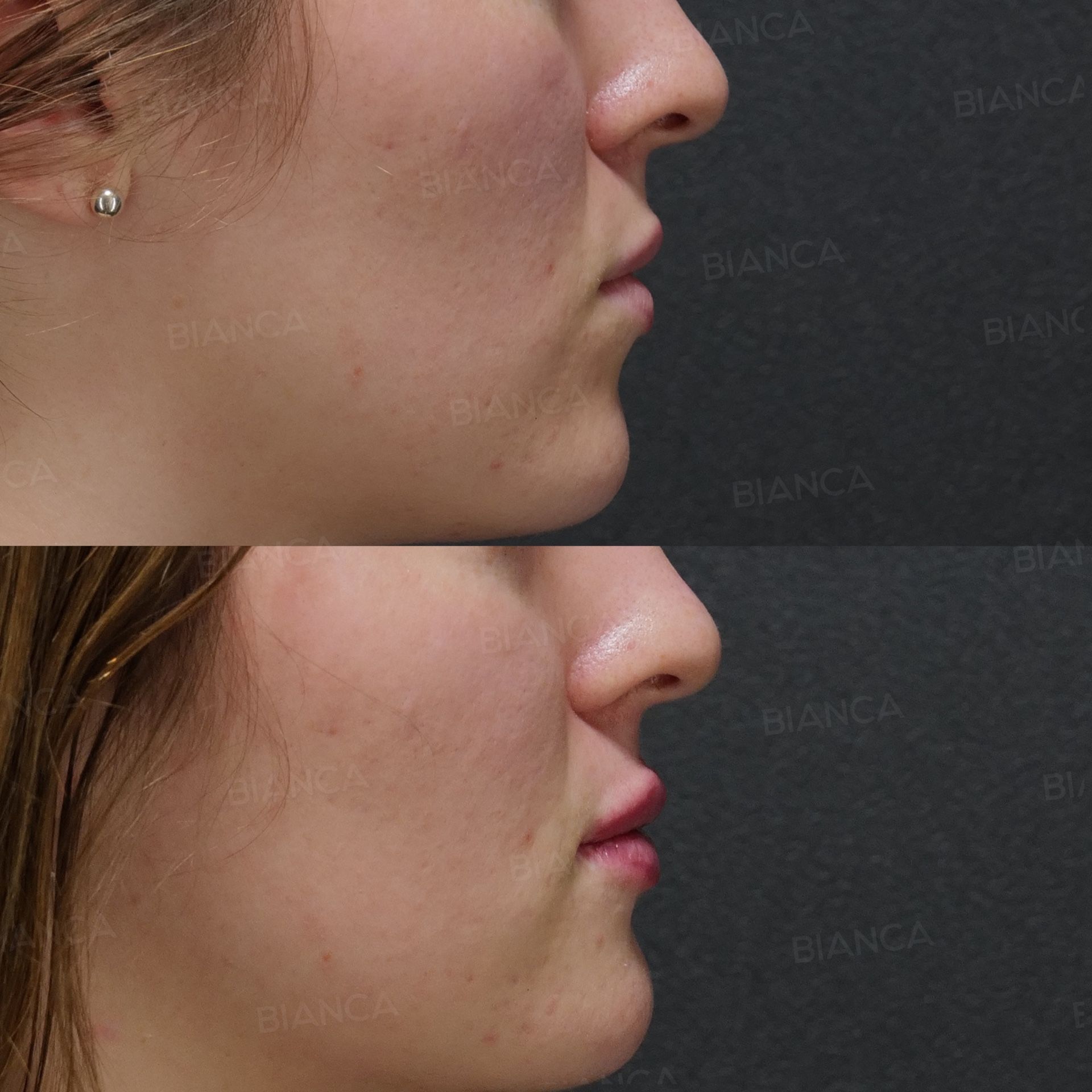 Hyaluronic acid lip filler before and after volume introduced gradually with NEAUVIA RHEOLOGY, side view, immediately after treatment