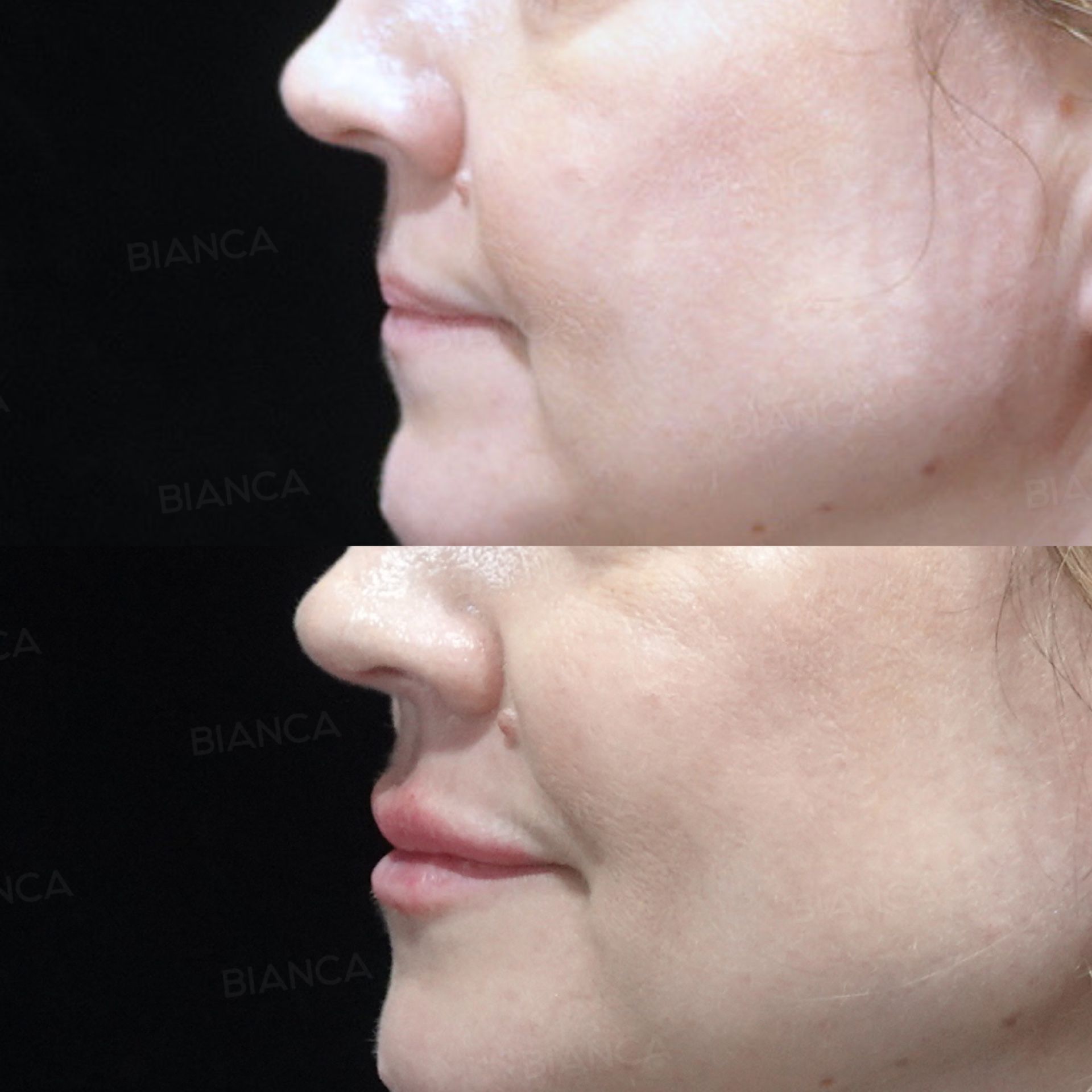 Hyaluronic acid filler before and after lip augmentation with Teosyal RHA 2, side view, immediately after treatment