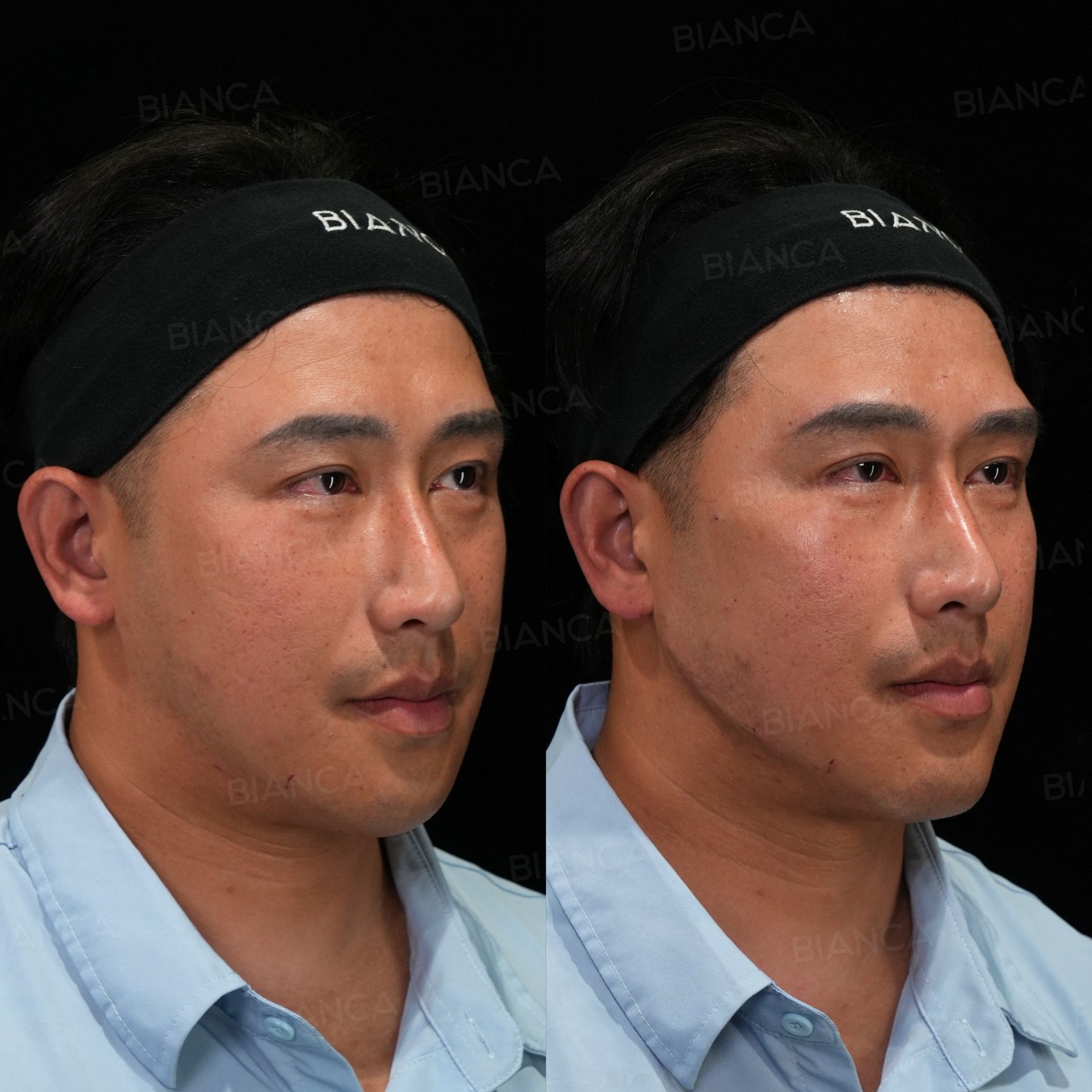 Hyaluronic acid filler before and after NEAUVIA STIMULATE in the midcheek groove, cheeks and chin, right three-quarter view, immediately after treatment